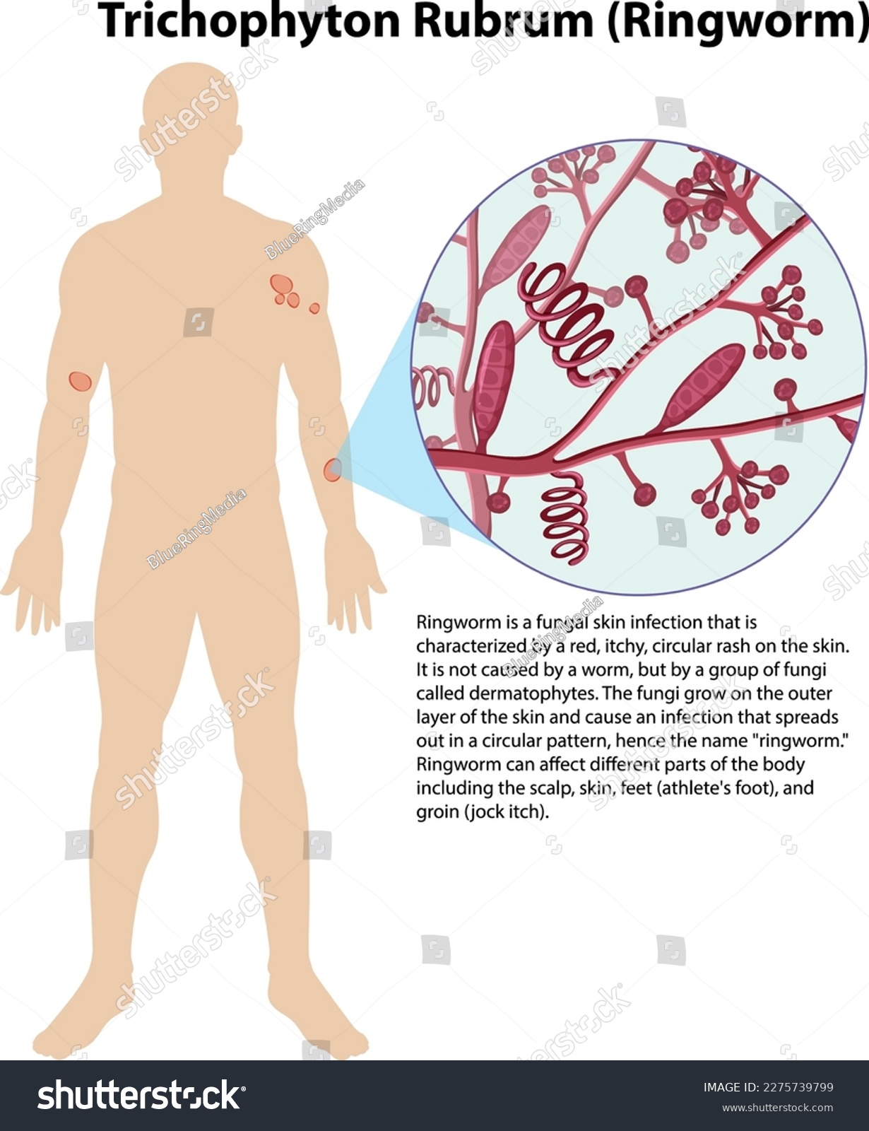 Trichophyton Rubrum Fungal Infection Royalty Free Stock Vector