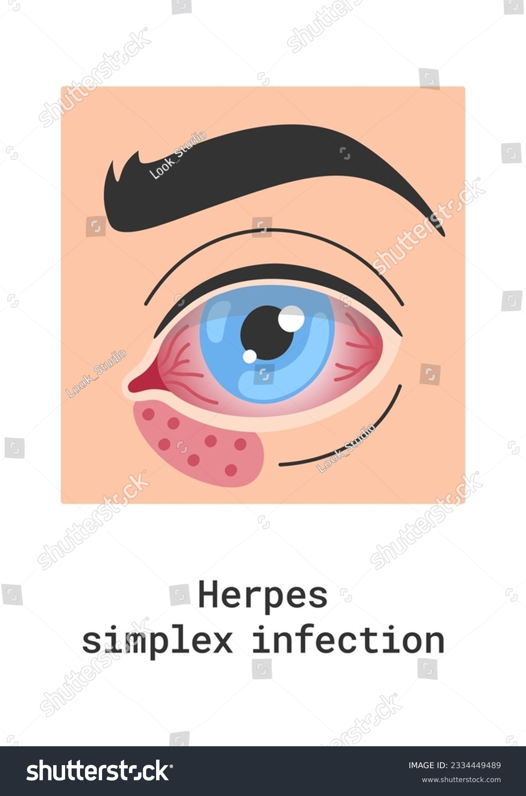 Herpes Simplex Infection Eye Disease Vector Royalty Free Stock Vector