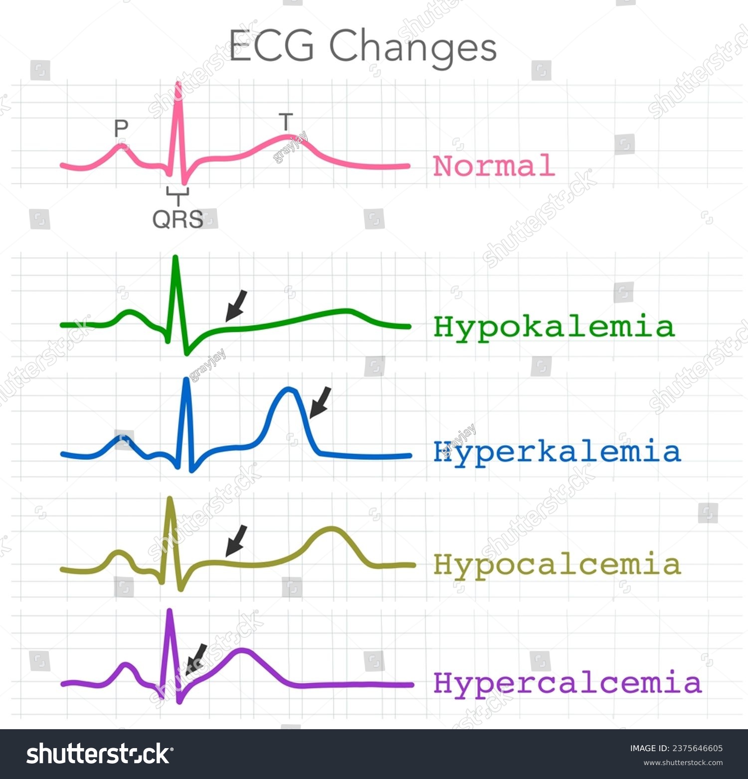 Ecg Changes Hypokalemia Hyperkalemia Royalty Free Stock Vector