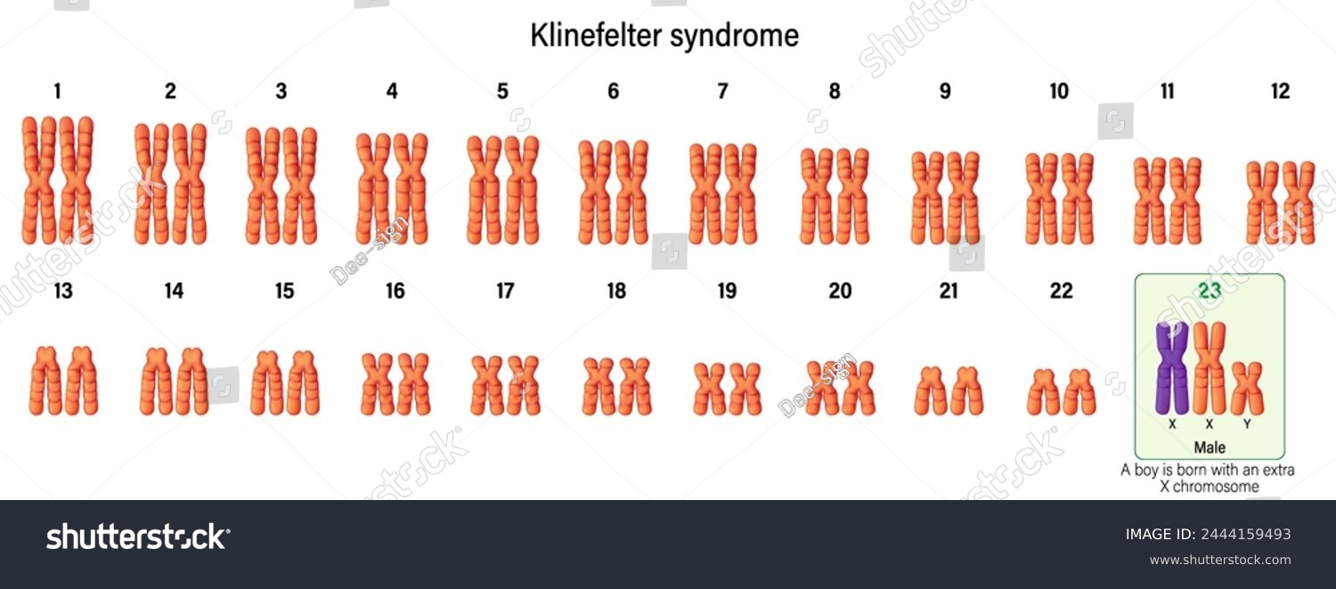 Karyotype Of Klinefelter Syndrome Klinefelter S Royalty Free Stock