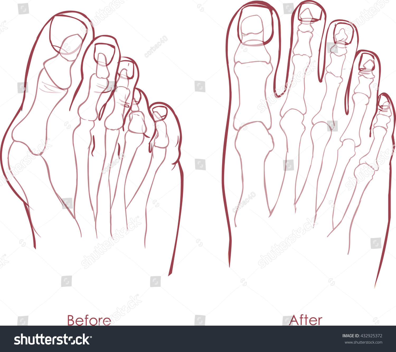 Human Foot Deformity Hallux Valgus And Tailors Royalty Free Stock