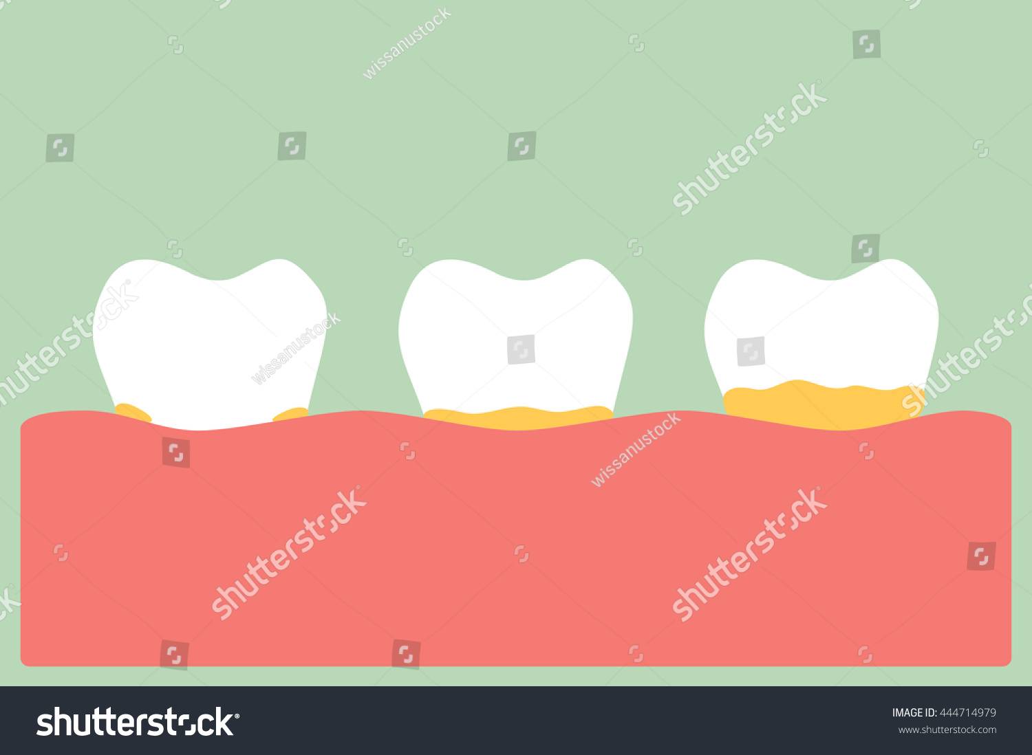 Dental Cartoon Vector Tooth Periodontal Disease Royalty Free Stock