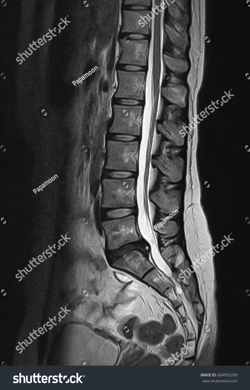 MRI Scan Sagittal View Lumbosacral Spine Has Royalty Free Stock Photo Avopix