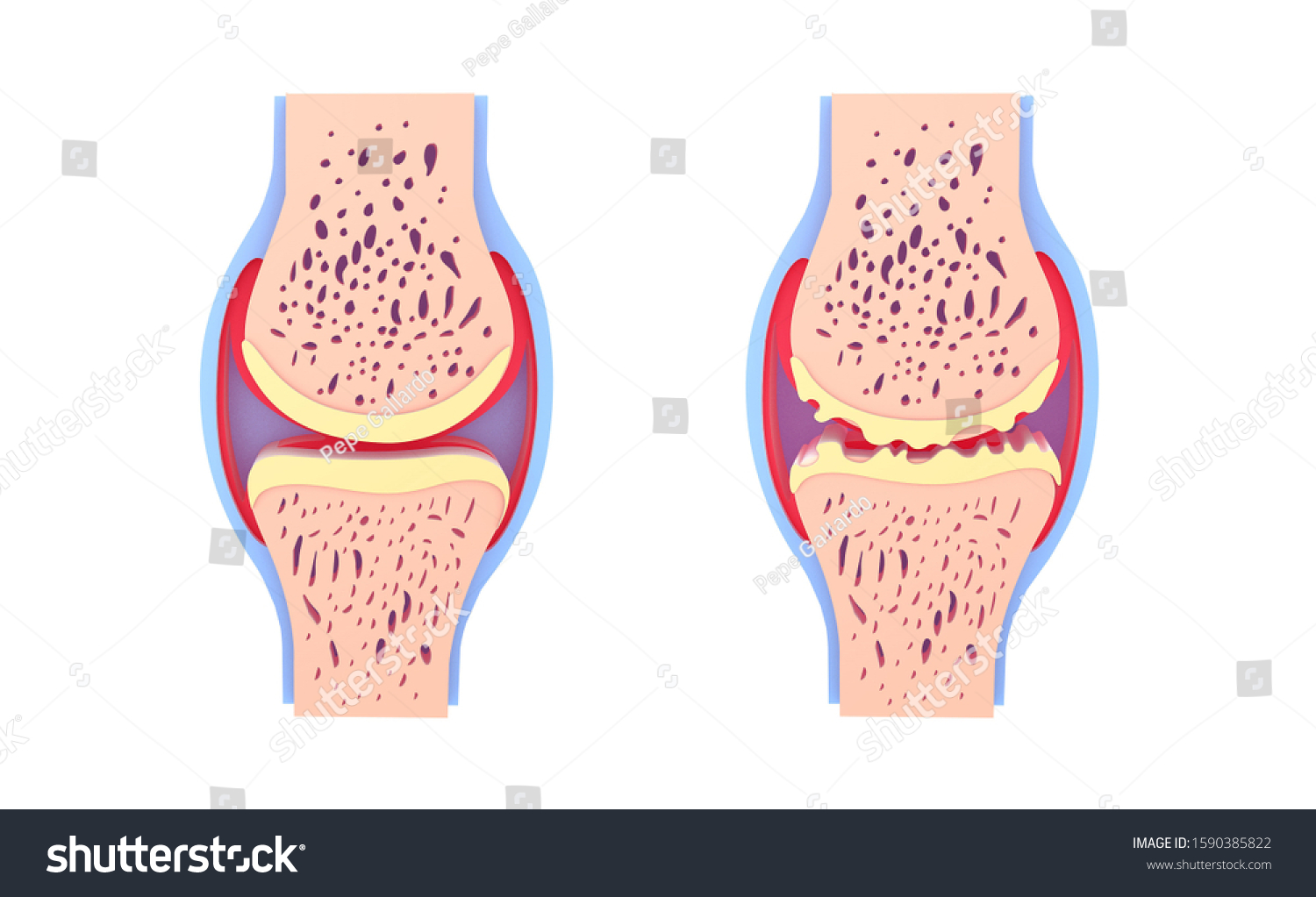 D Illustration Healthy Synovial Joint Osteoarthritis Stock