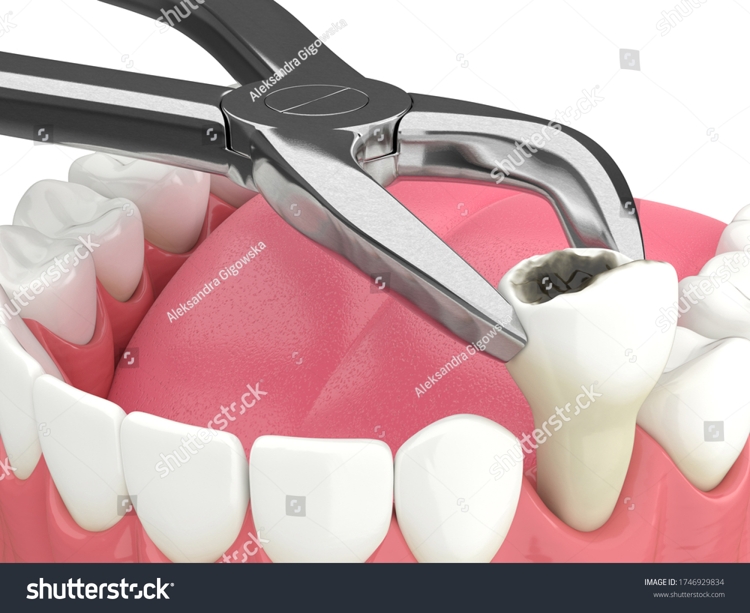 Dental Extraction Images Stock Photos Vectors Shutterstock