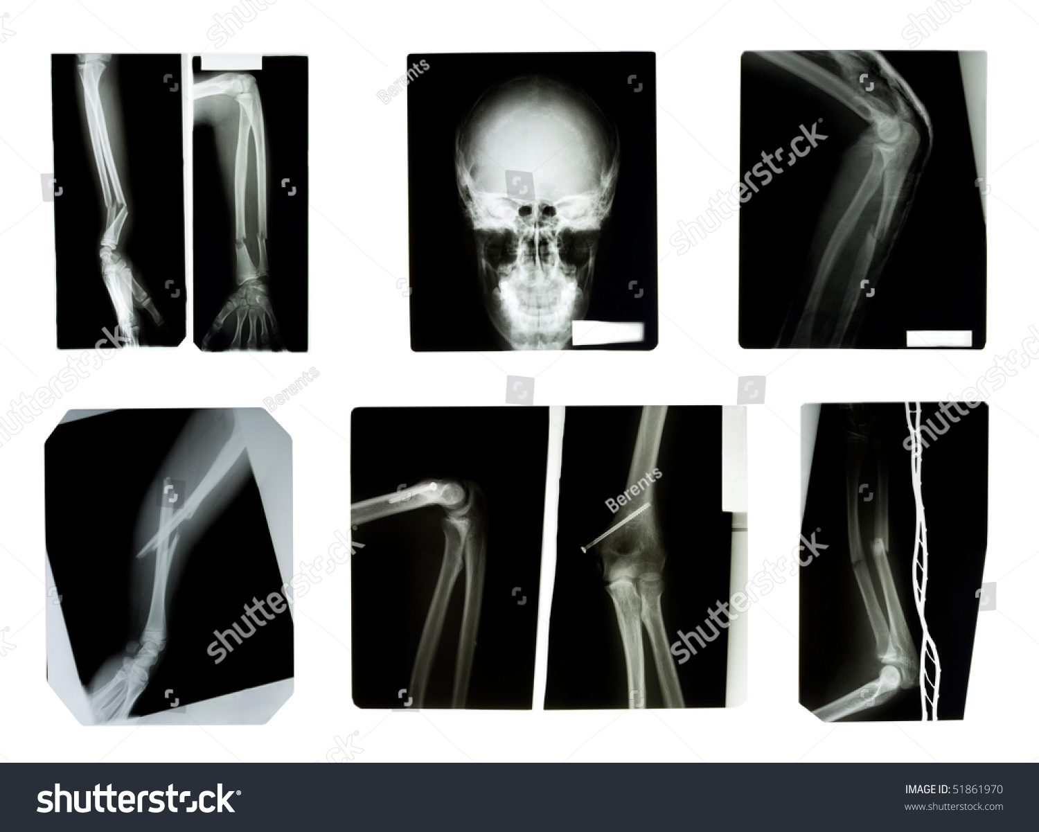 Xrays Collection Broken Bones Stock Photo 51861970 - Shutterstock