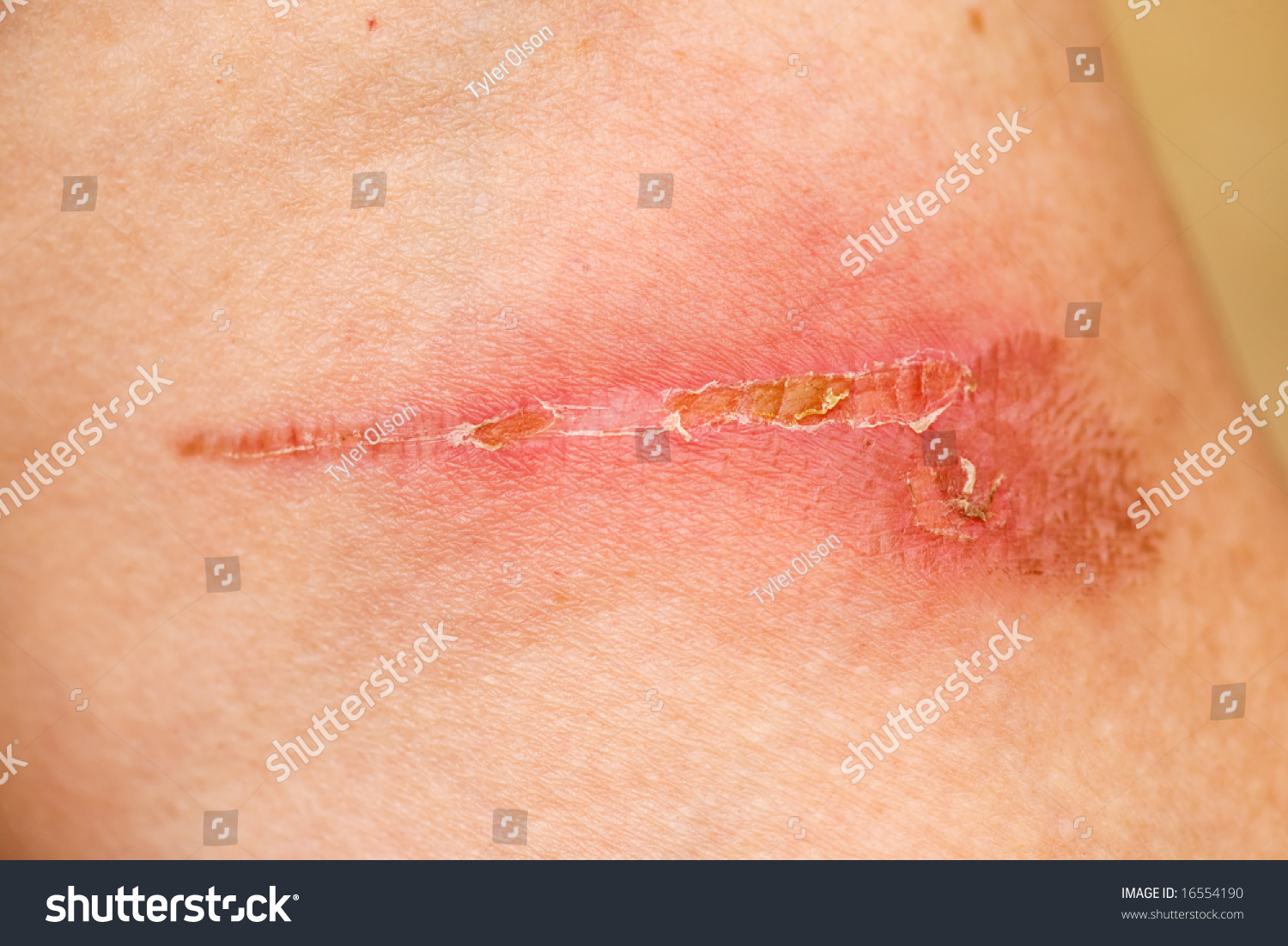 burn scar stock photo 57476164 a burn scar that is partly healed stock photo 16554190 burn scar stock photo 57476164 a burn scar that is partly healed stock photo 16554190