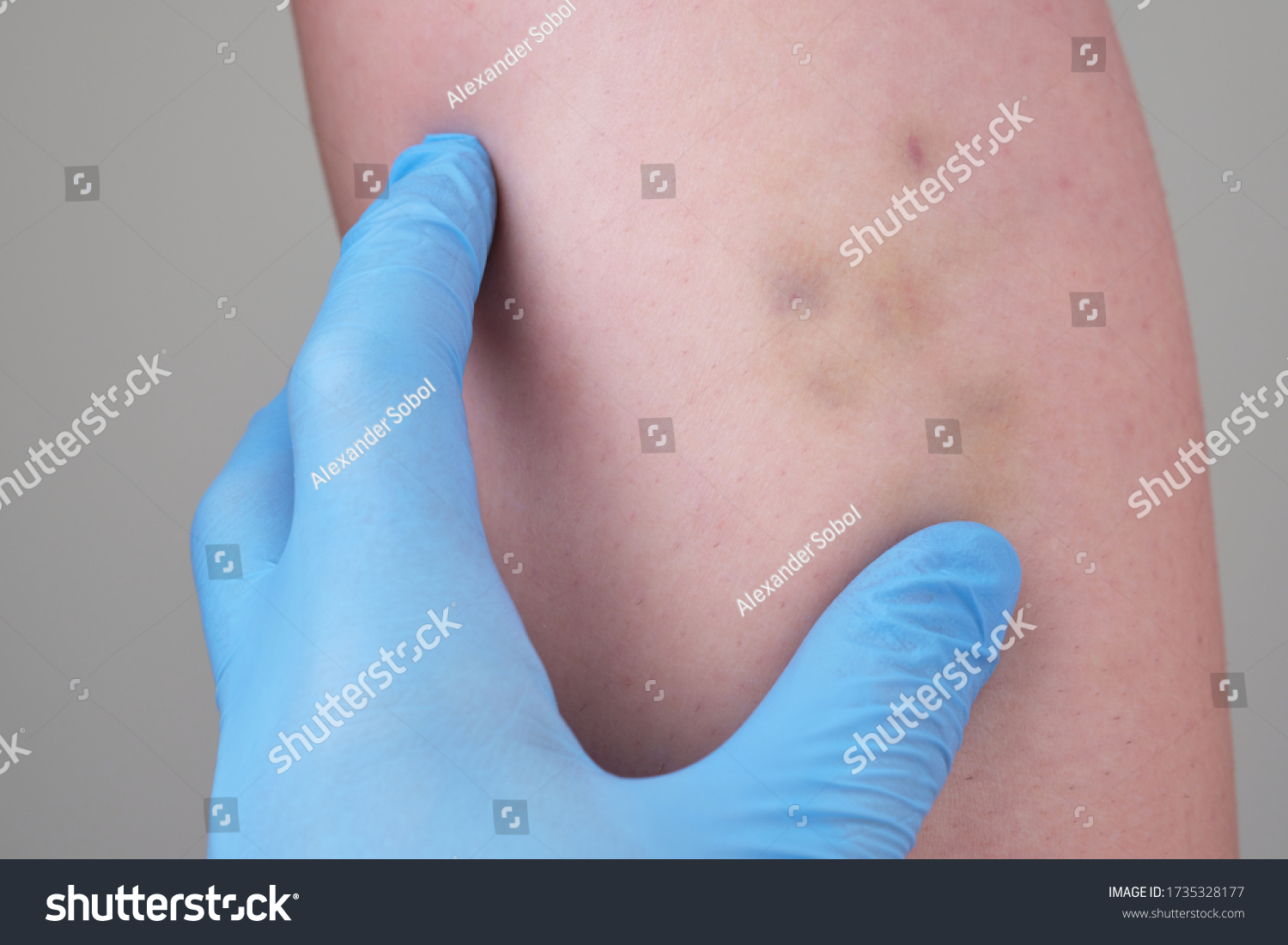 Large Bruise Hematoma On Girls Leg Stock Photo Shutterstock