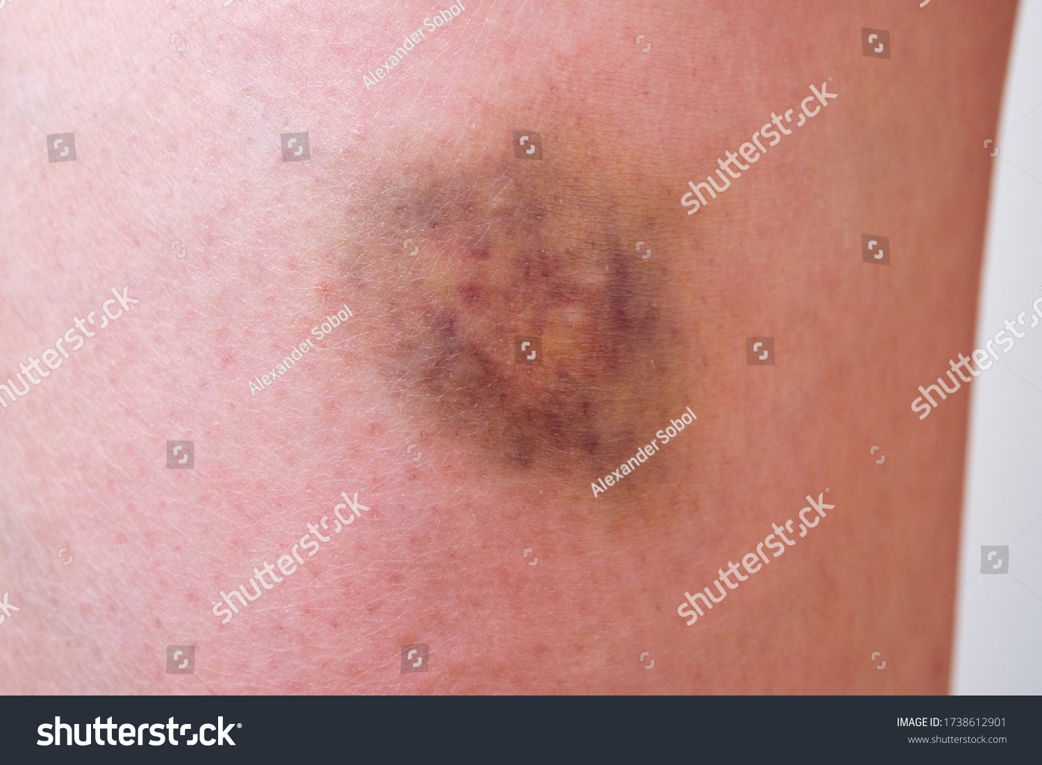 Large Bruise Hematoma On Girls Leg Stock Photo 1738612901 Shutterstock