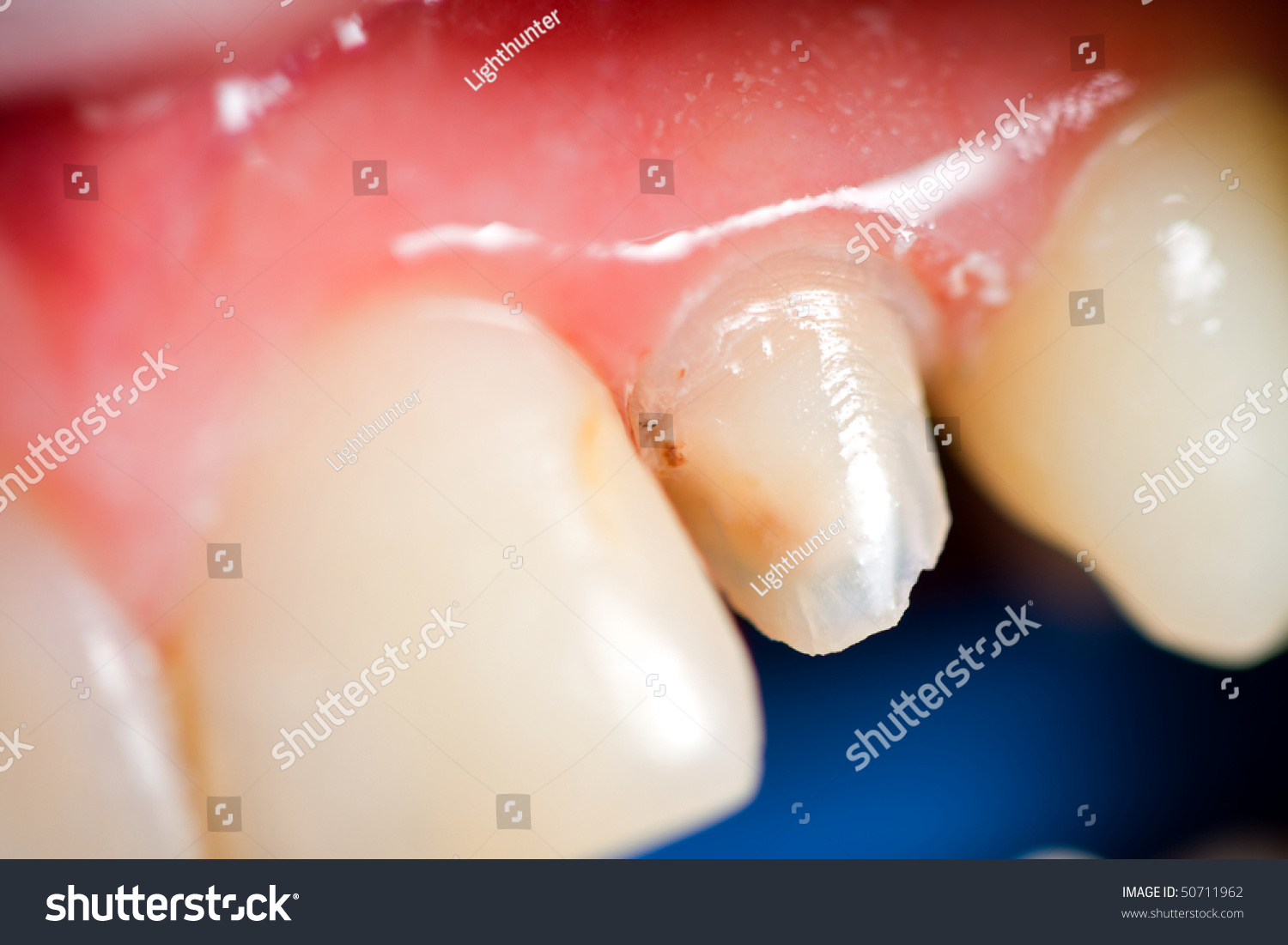 A Macro Shot Of A Discolored Tooth After Root Canal Treatment With