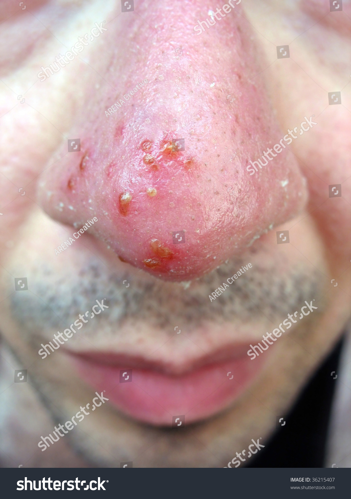 Herpetic stomatitis: MedlinePlus Medical Encyclopedia