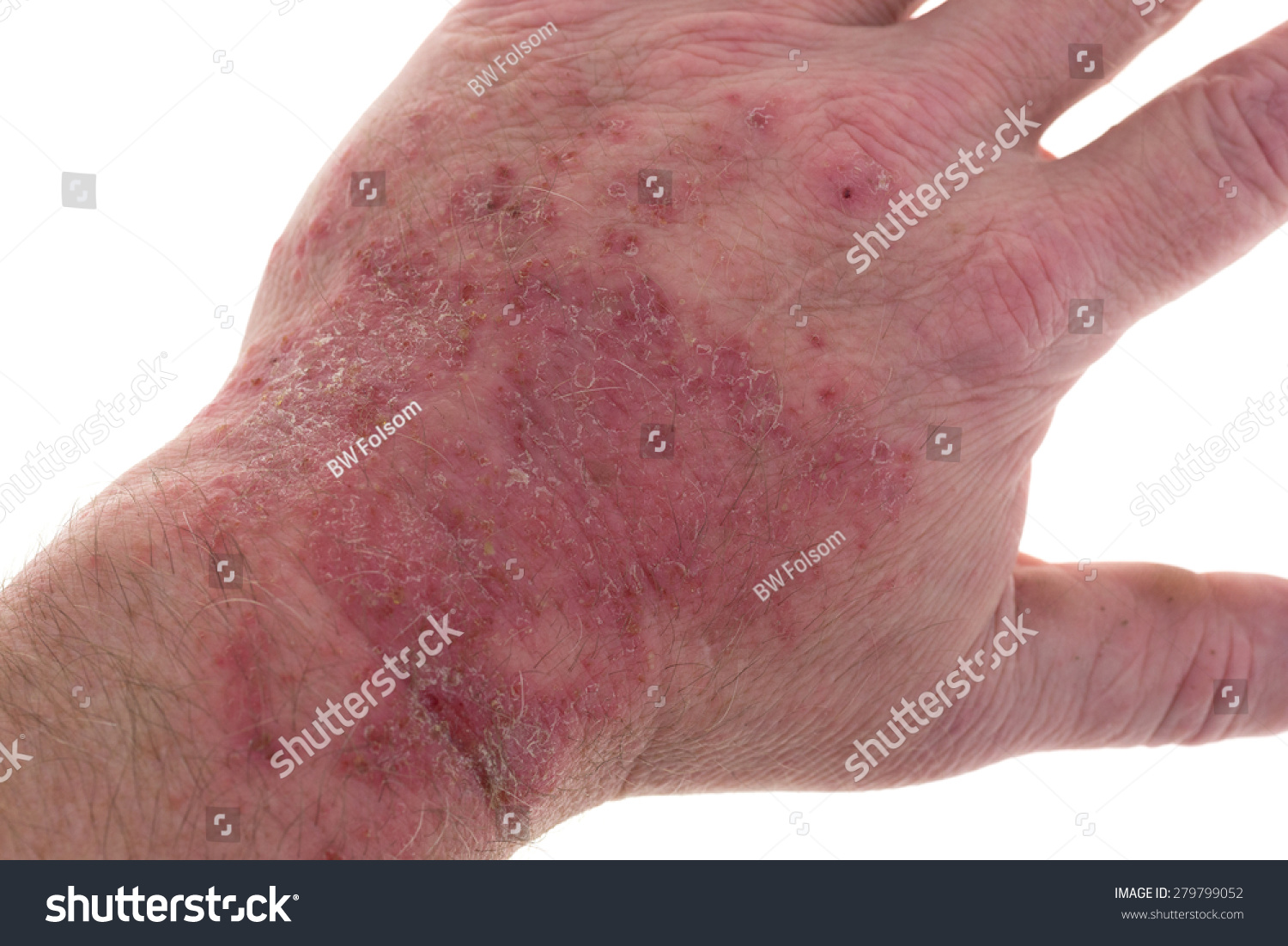 a-severe-reaction-to-latex-on-the-top-of-a-male-hand-stock-photo
