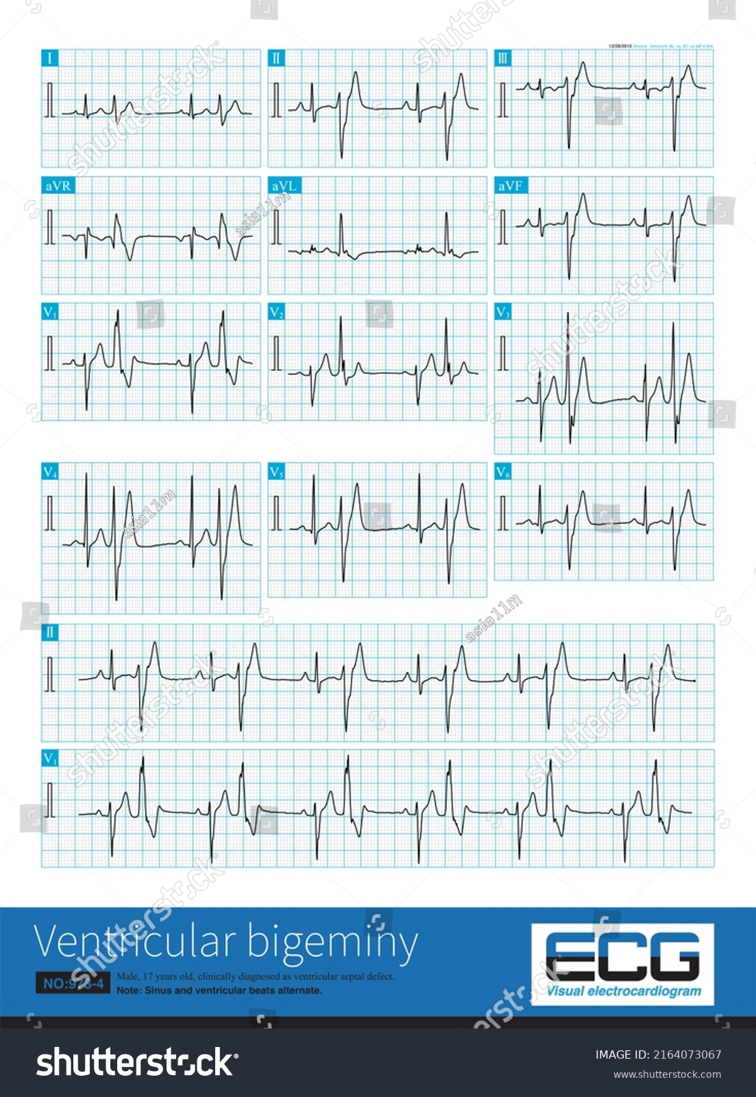 Year Old Male Clinically Diagnosed Stock Illustration