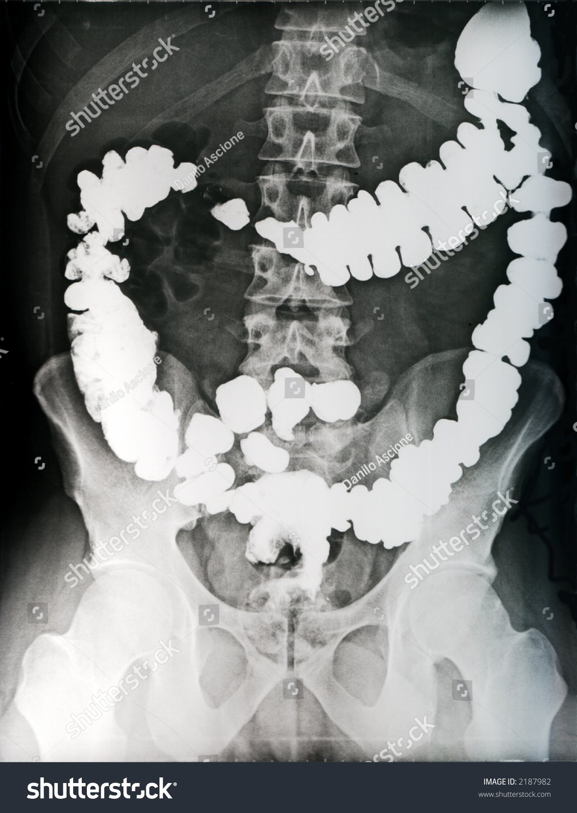 Abdomen Radiography With Contrasted Intestine Stock Photo 2187982 