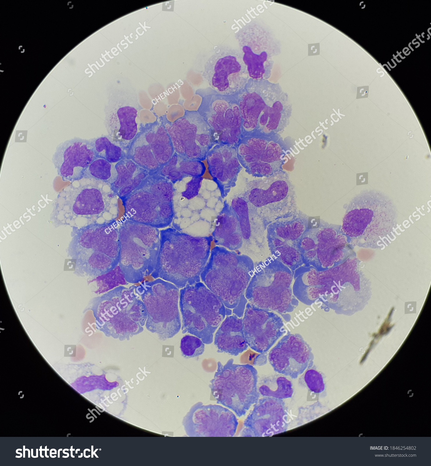 Abnormal Cells Body Fluids Stock Photo Shutterstock