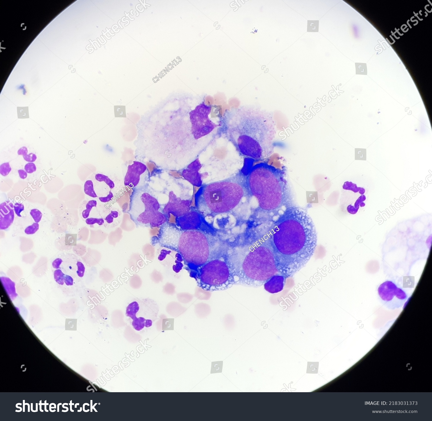 Abnormal Cells Body Fluids Stock Photo 2183031373 Shutterstock