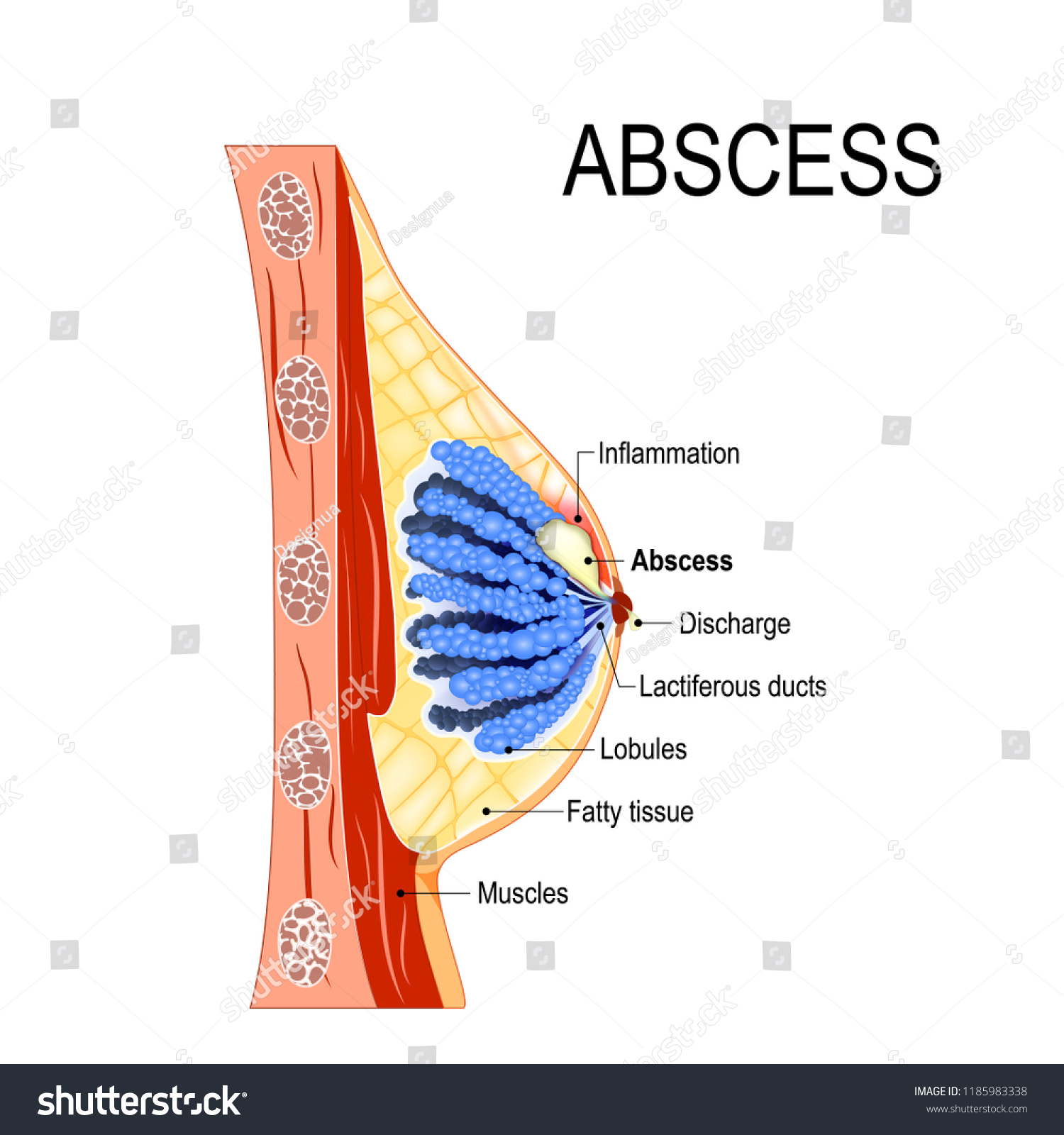 Abscess Crosssection Mammary Gland Inflammation Breast