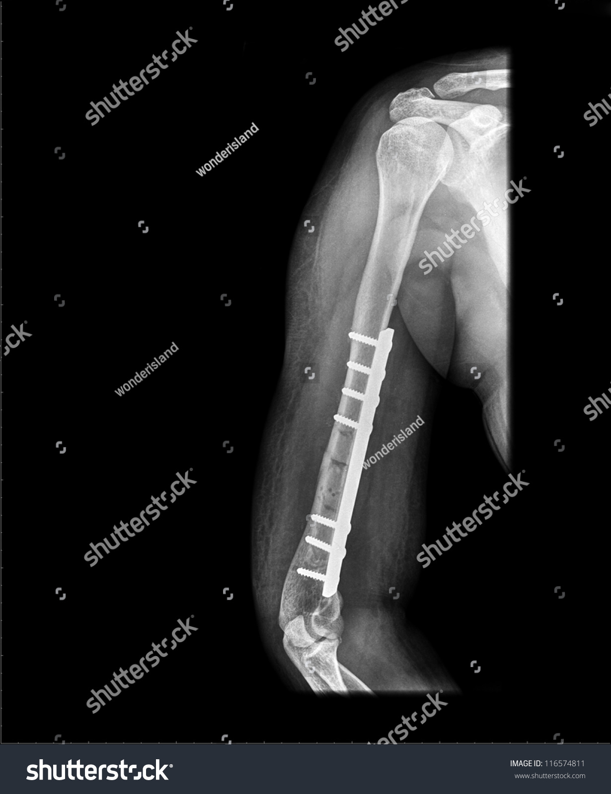 Arm X Ray Stock Photo 116574811 Shutterstock