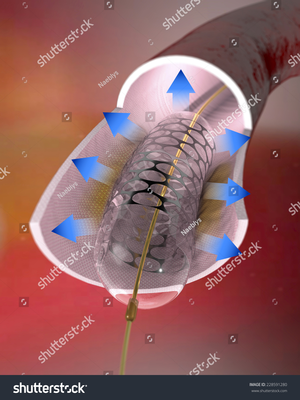 Artery And A Stent Inside It. A Stent Is A Mesh Tube Implanted Into A Narrowed Artery To Keep