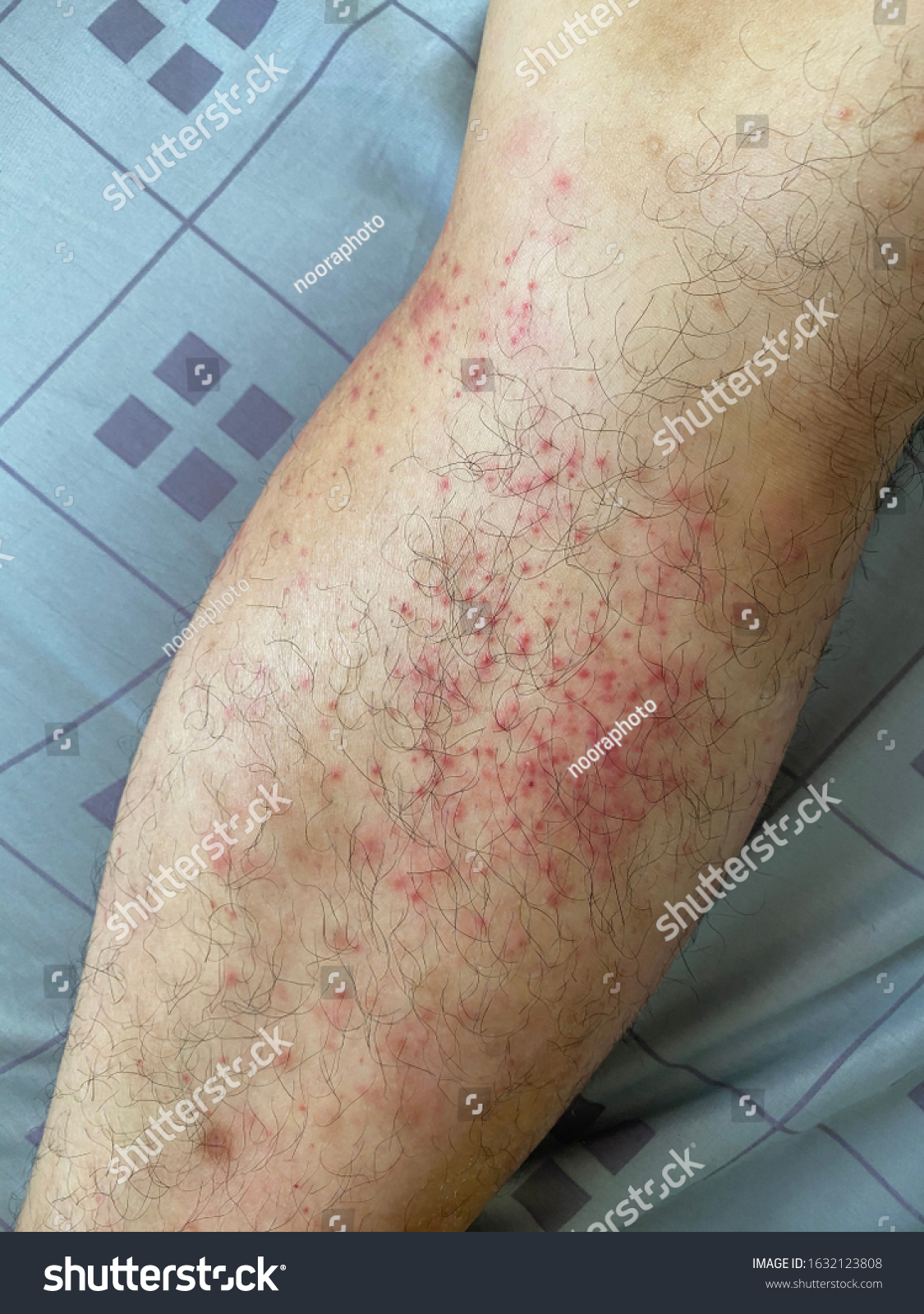 Atopic Dermatitis Rashes On Man Leg Photo De Stock Modifiable