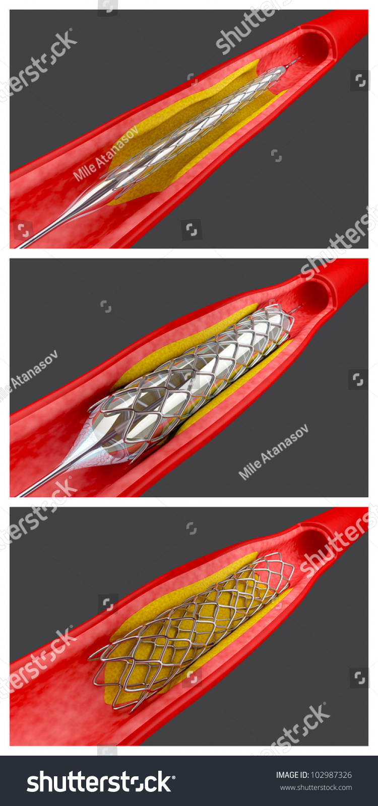 Balloon Angioplasty Procedure With Placing A Stent Stock Photo ...