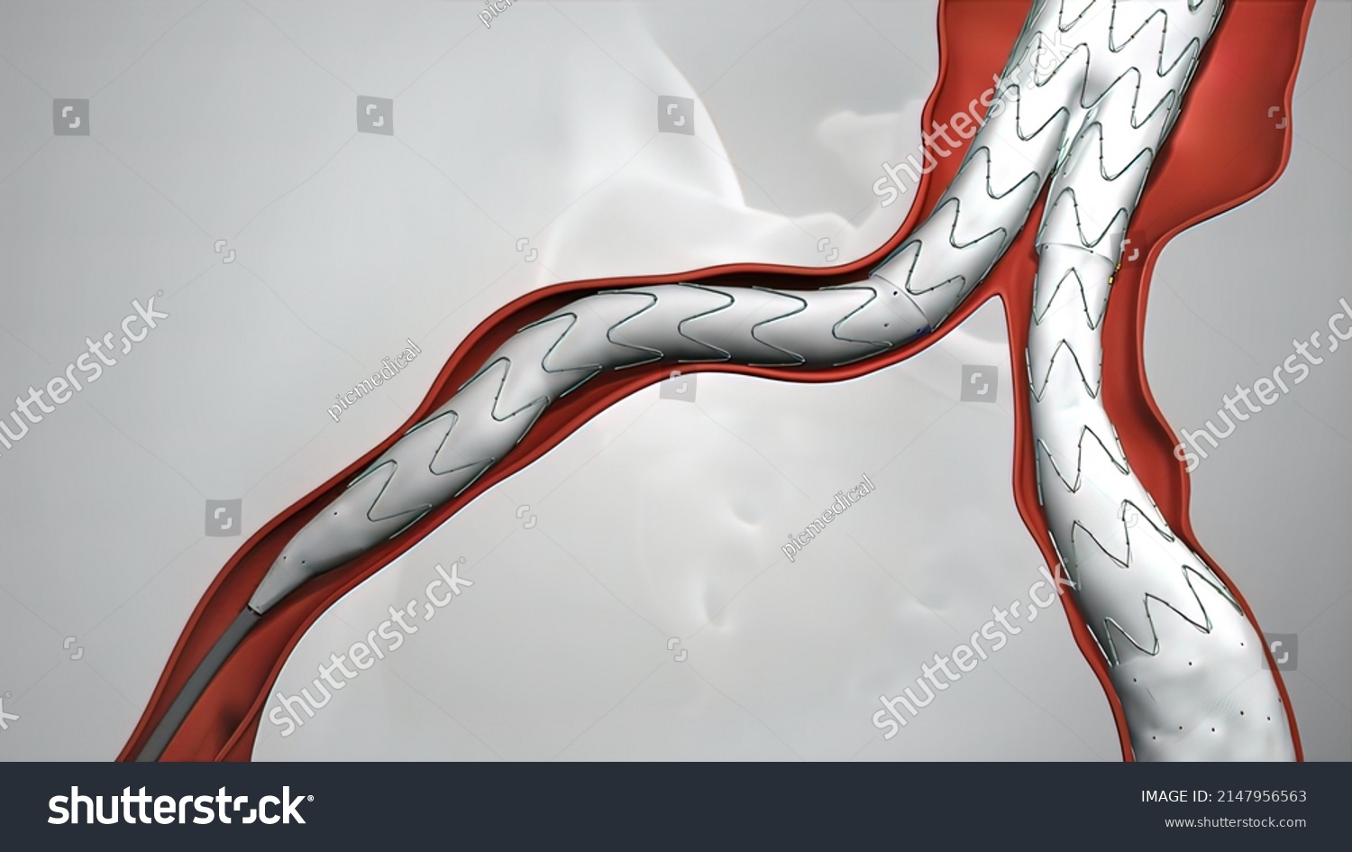 Balloon Angioplasty Procedure Stent Vein D Stock Illustration