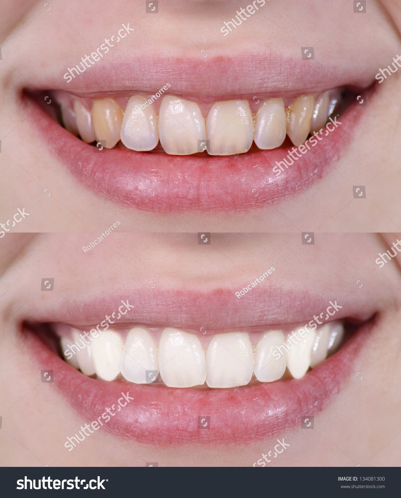 Before And After Dental Treatment Stock Photo 134081300 ...