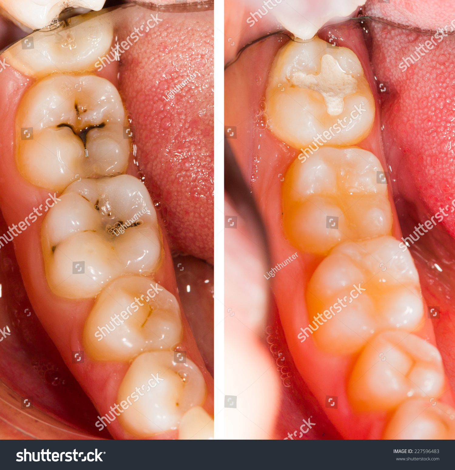 Before And After Dental Treatment - Beforeafter Series ...