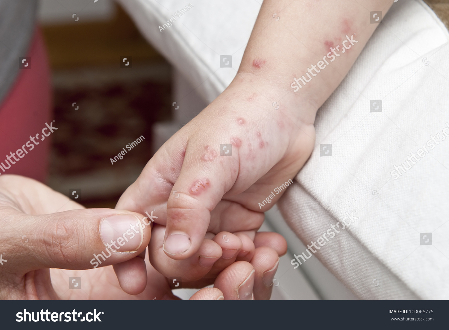 blisters-caused-by-herpes-zoster-in-the-hand-and-arm-of-a-child-stock