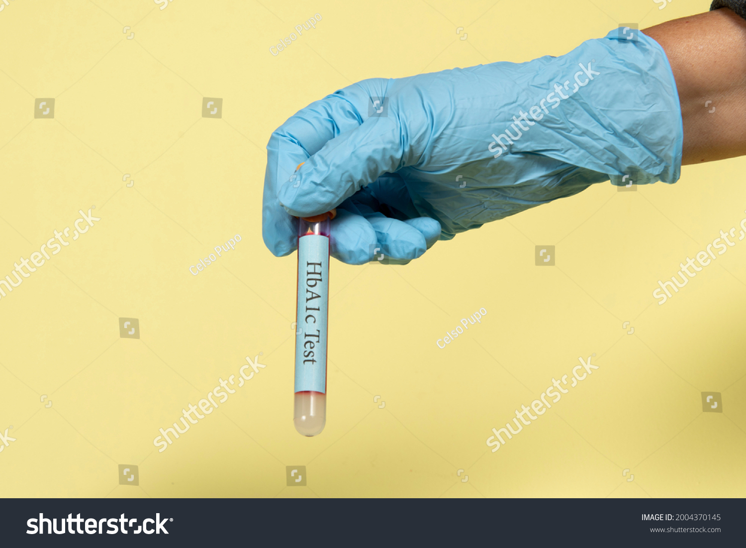 Blood Sample Vacuum Tube Hemoglobin Hba1c Stock Photo 2004370145