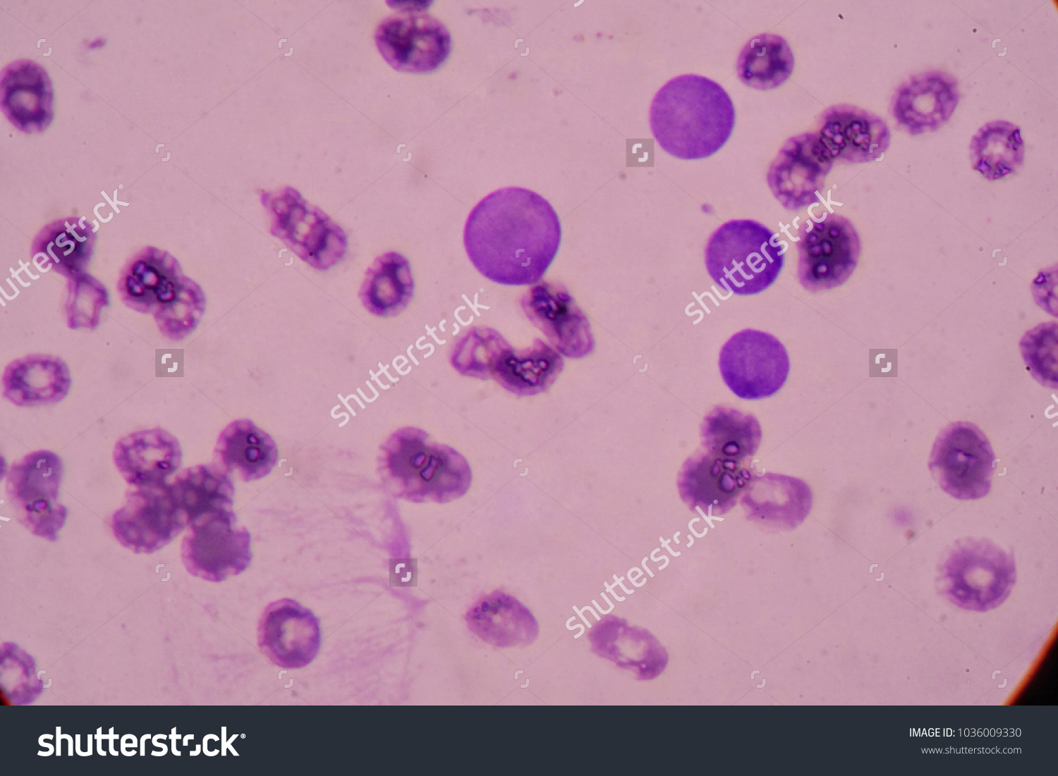 Blood Smear Under Microscopy Showing Chronic Stock Photo Edit Now