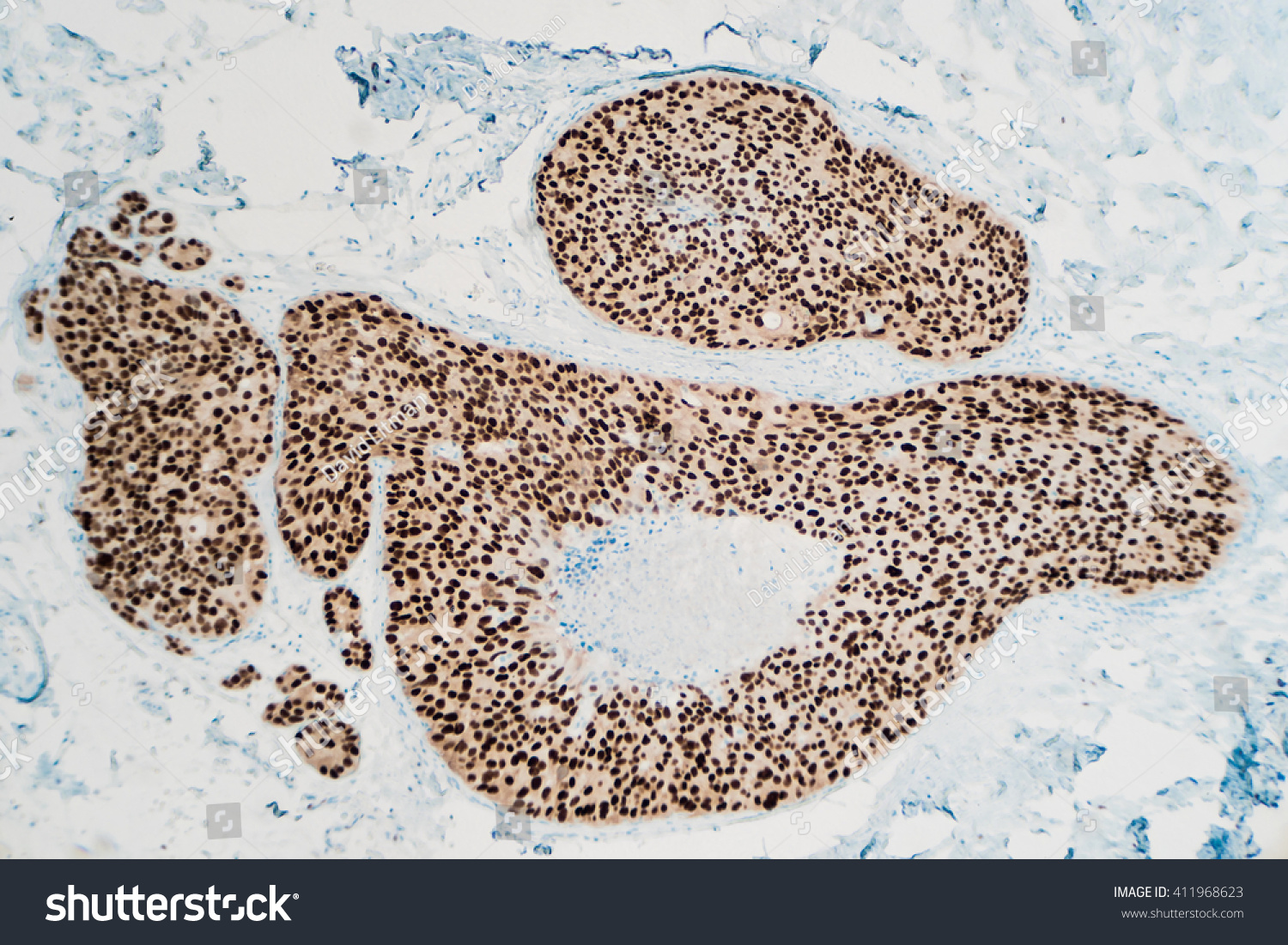 The Dcis and breast cancer read Never impossible Dcis and breast cancer