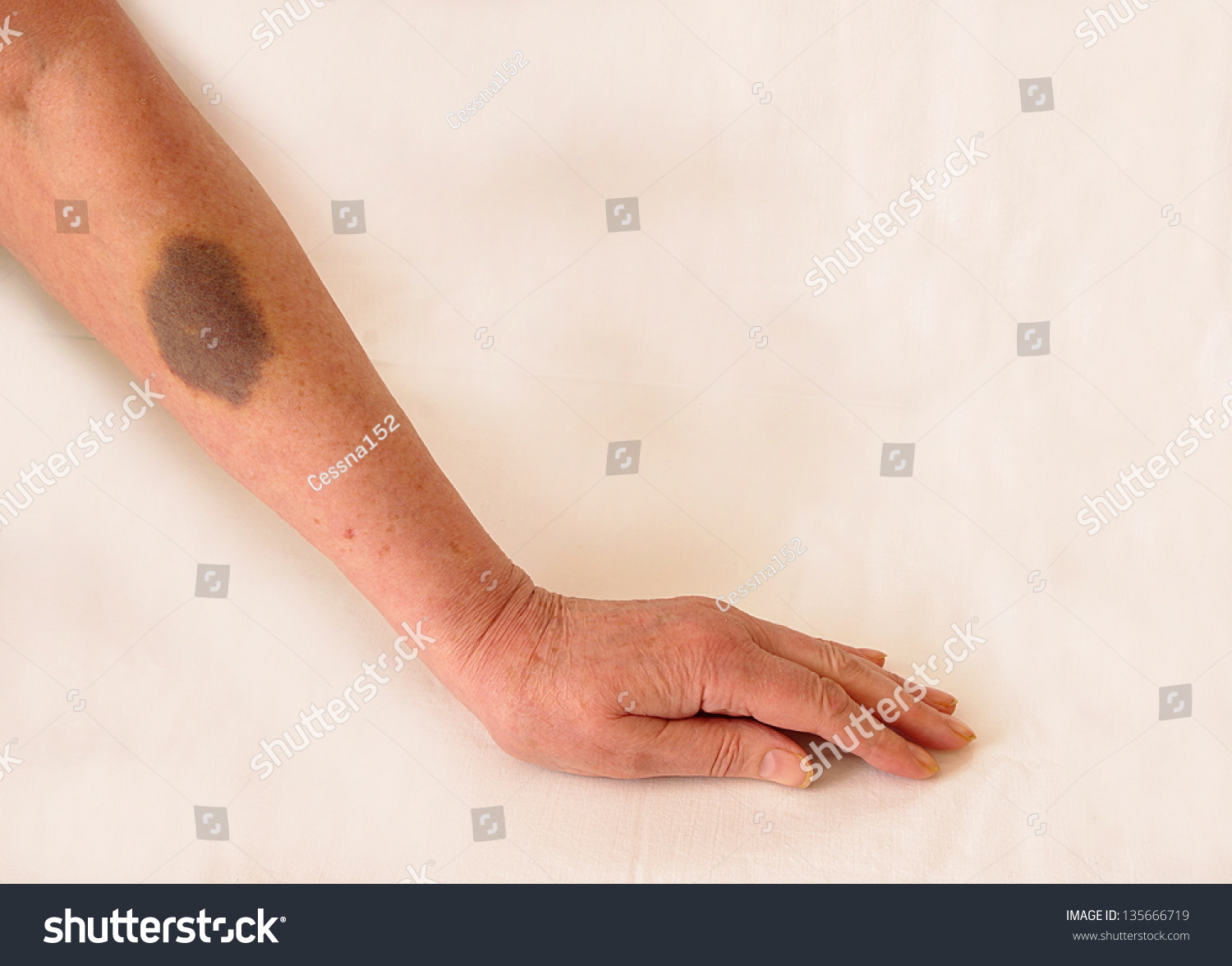 Bruise After Drawn Blood On Arm Stock Photo 135666719 Shutterstock