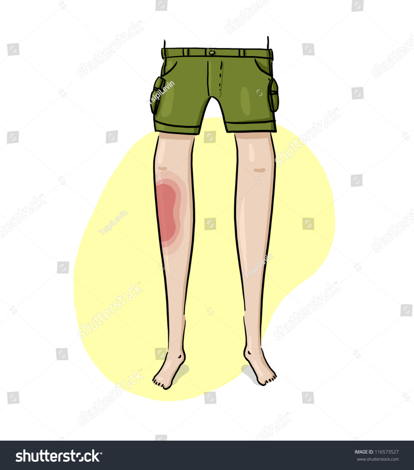 Bruised Leg Illustration; Injured Leg Drawing; Front View Of A Bruised