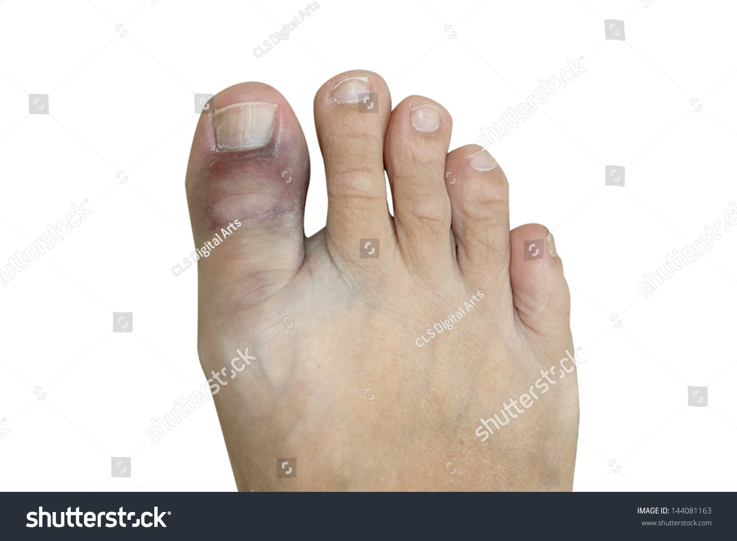 Bruised Sprained Broken Big Toe Isolated Stock Photo