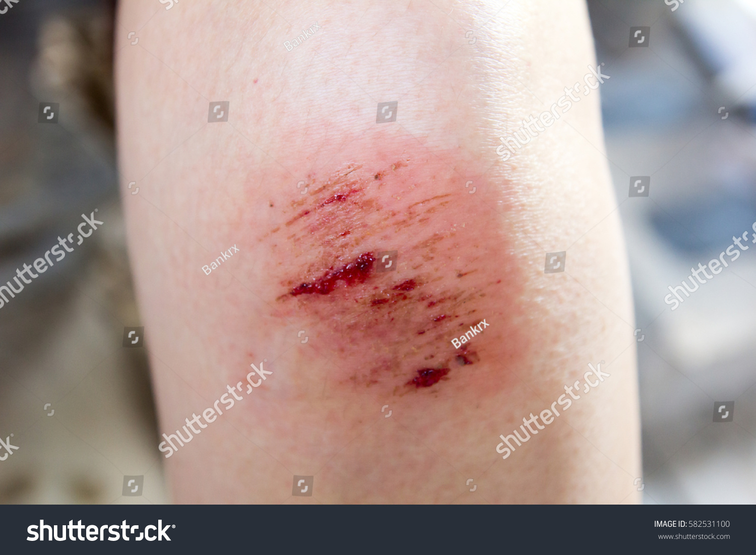 Bruised Wound Injury On Woman Knee Stock Photo Edit Now 582531100