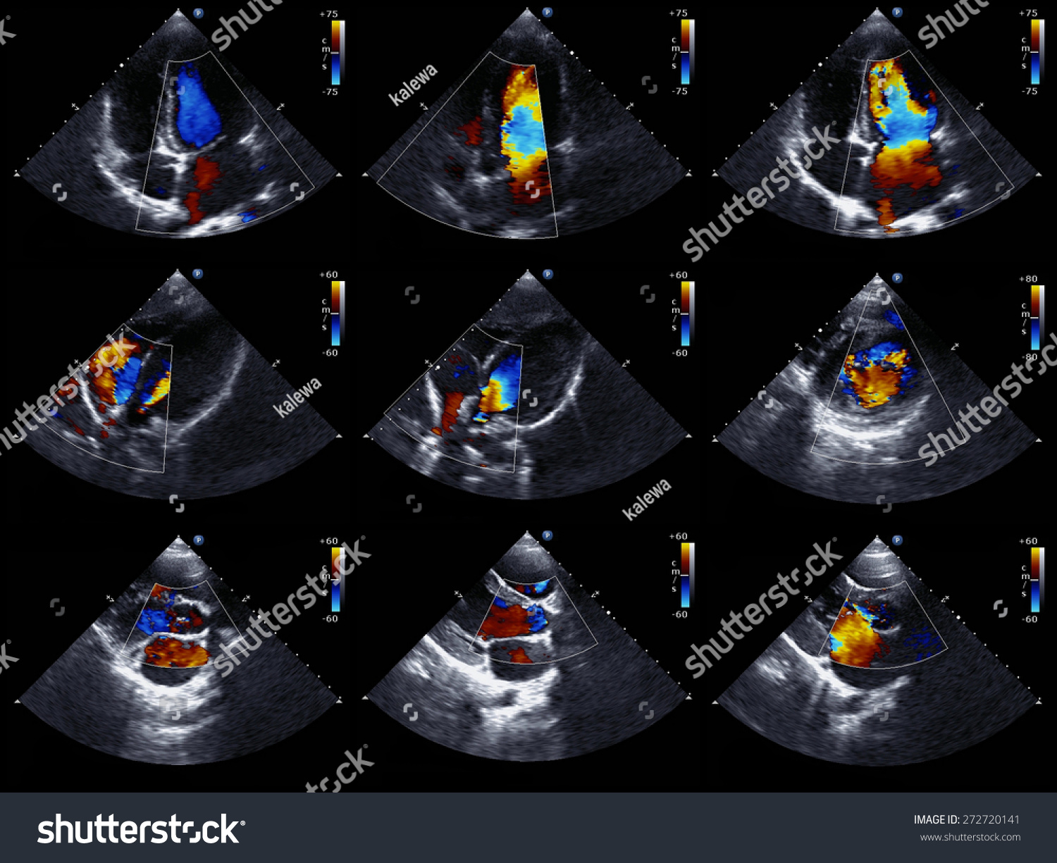 Cardiac Ultrasound Images Color Doppler Echo Stock Photo 272720141