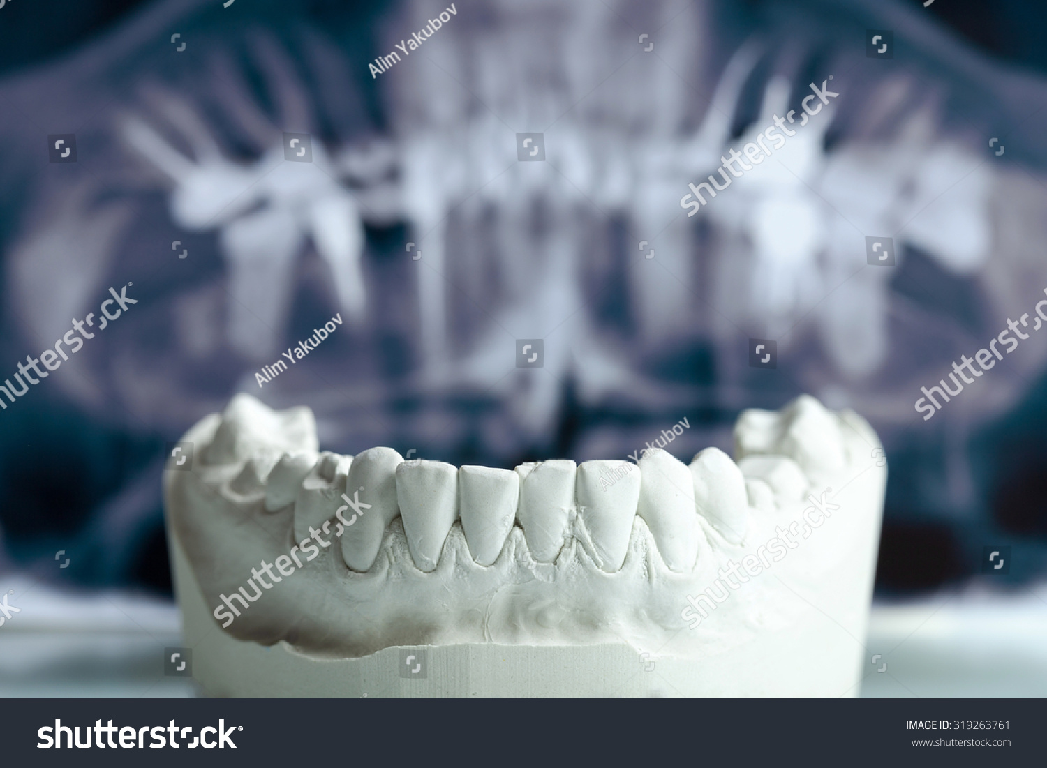 cast tooth cast tooth