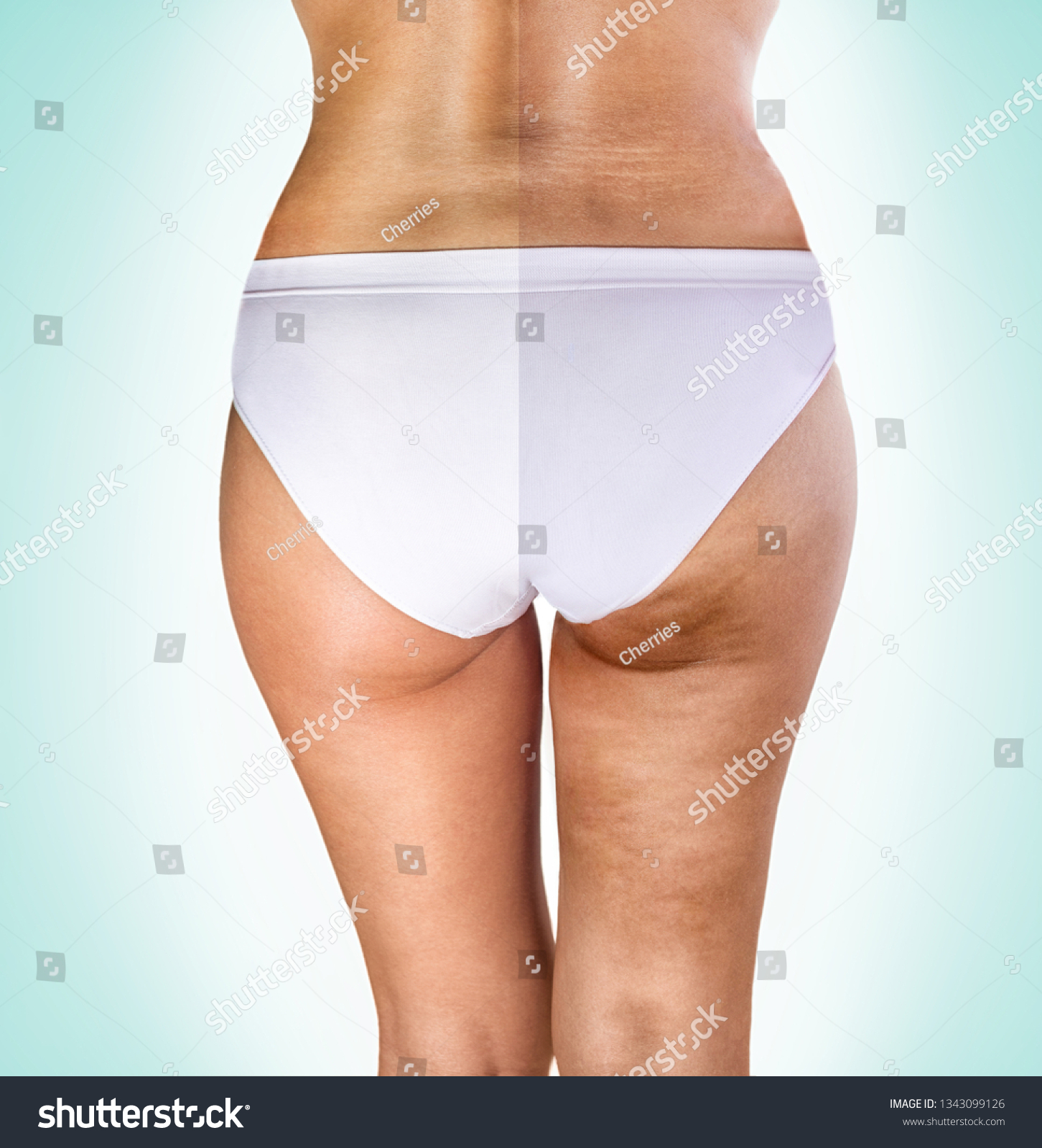 Cellulite Treatment Female Buttocks Before After Stock Photo