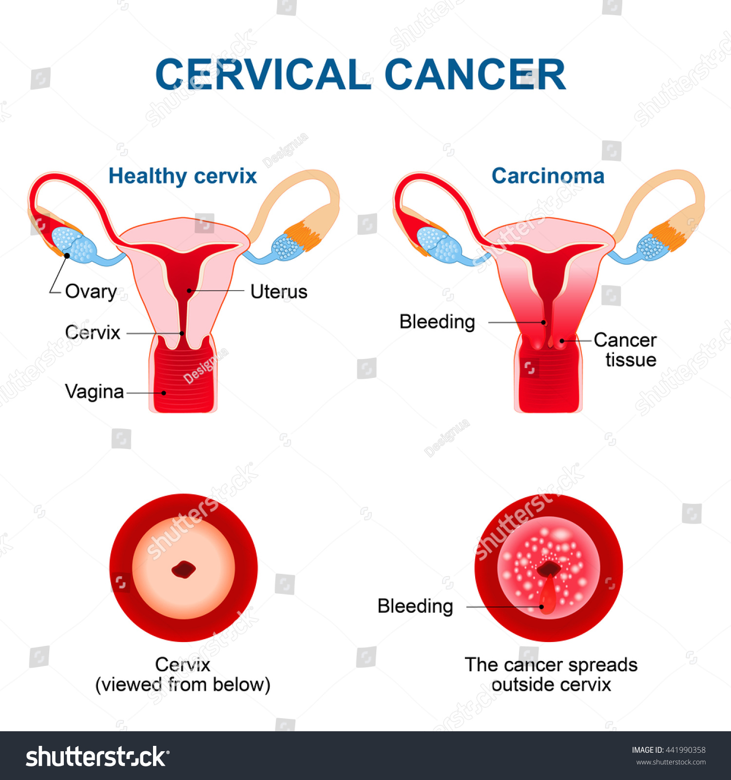 Cervical Cancer Malignant Neoplasm Arising From Cells In The Cervix Uteri Vaginal Bleeding