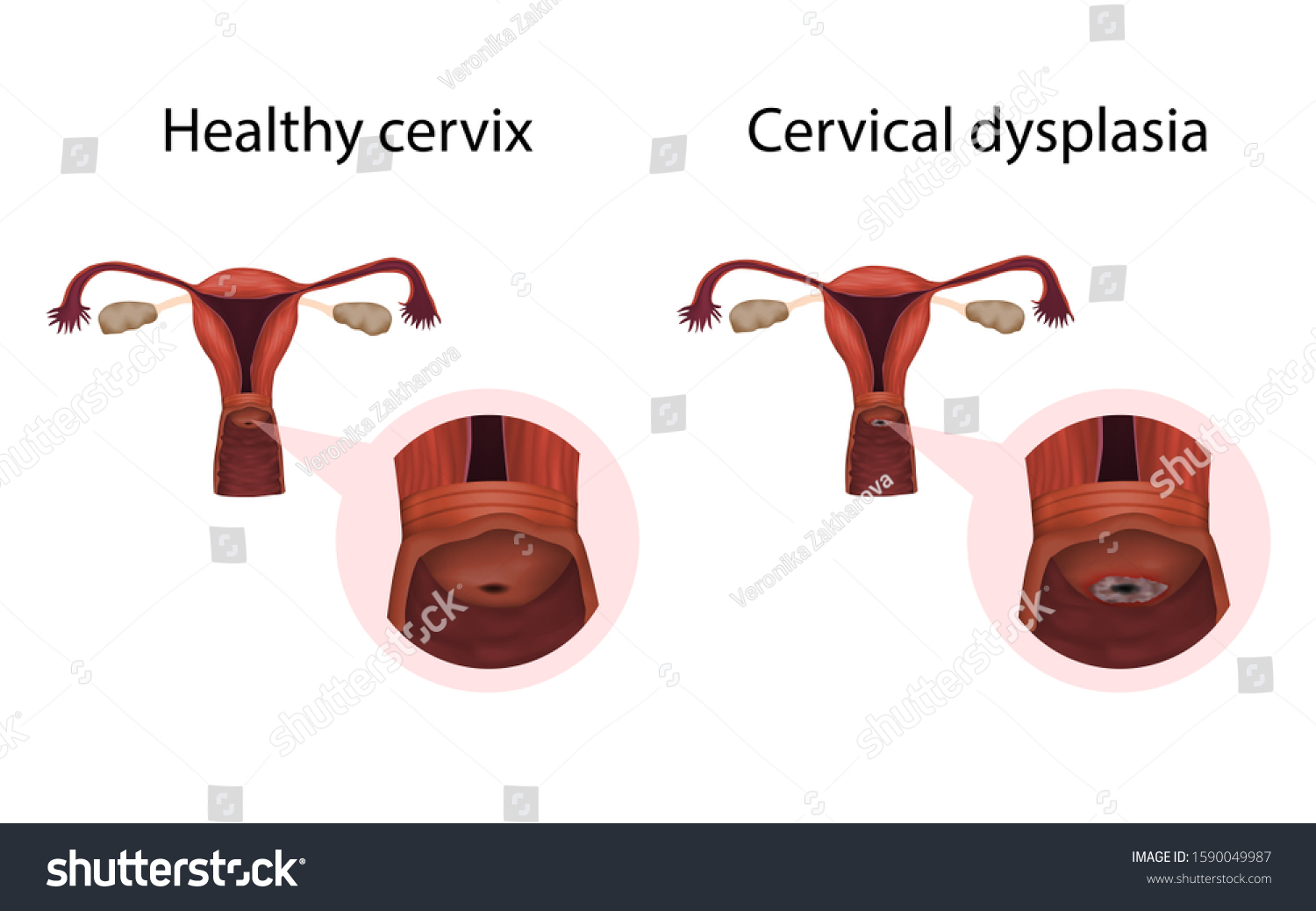 Cervix Dysplasia Healthy Organ Cervical Disease Stock Illustration