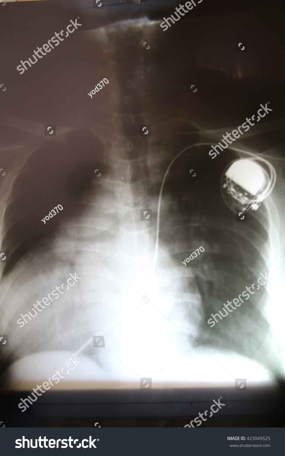 Chest With The Pacemaker On X Rays Film Stock Photo