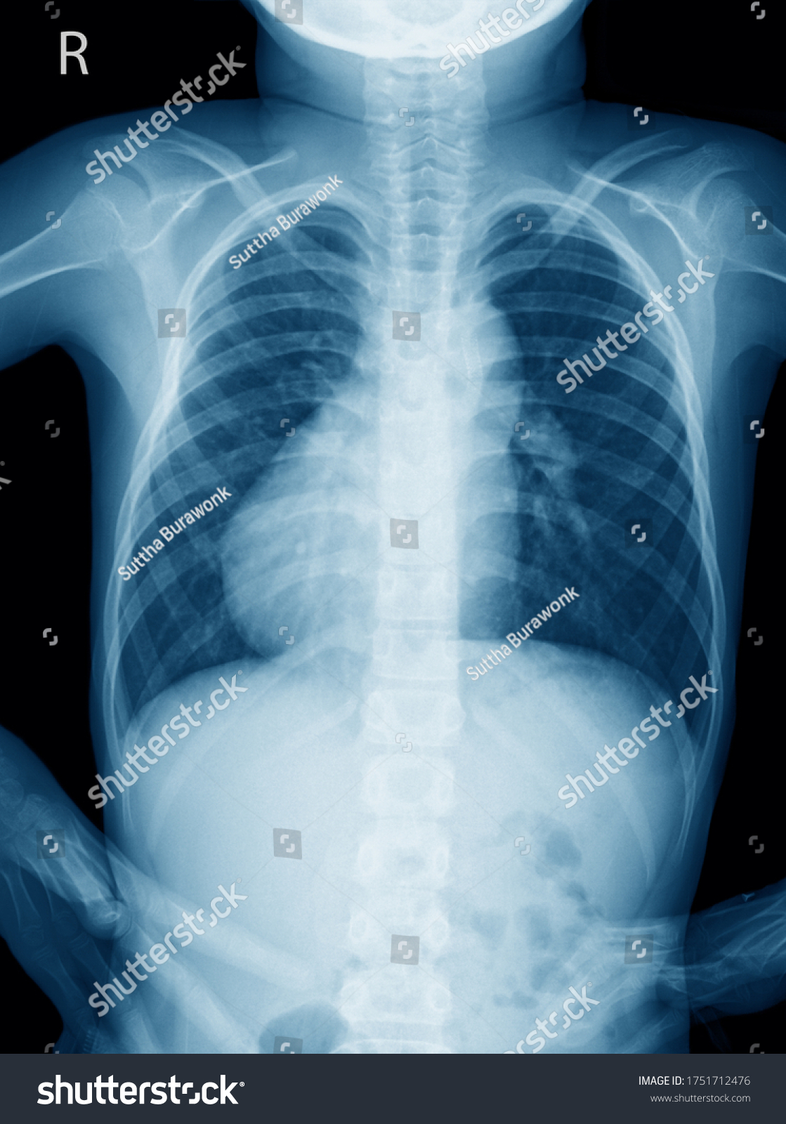 39 imágenes de Situs inversus Imágenes fotos y vectores de stock