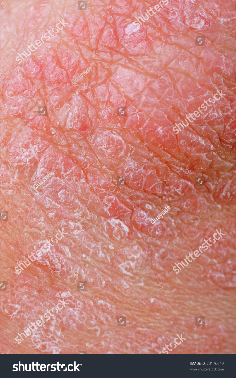 Close Up Of A Patients Elbow Showing Plaques Of Dry Skin Typically Seen