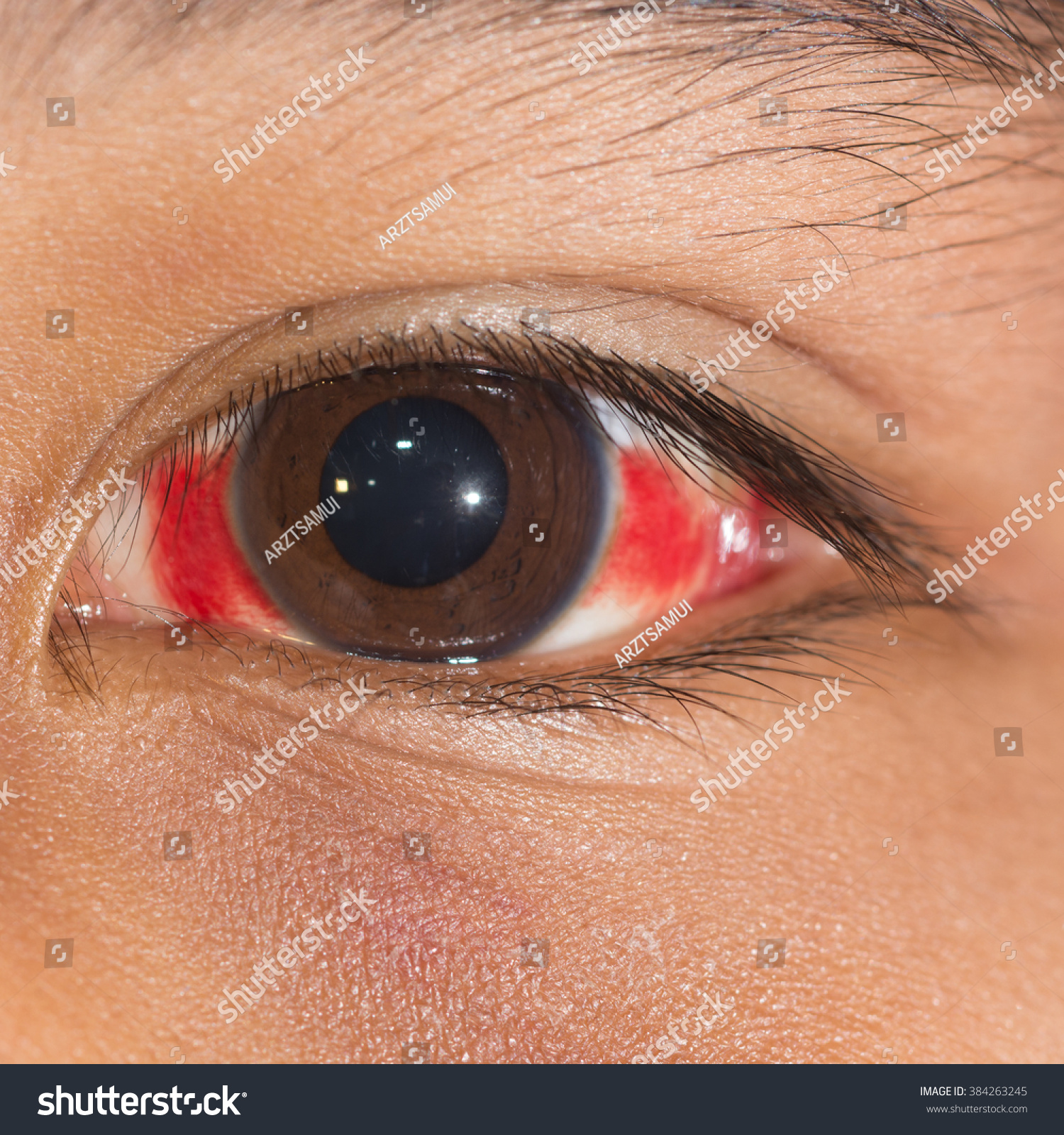 Close Subconjunctival Hemorrhage During Eye Examination Stock Photo