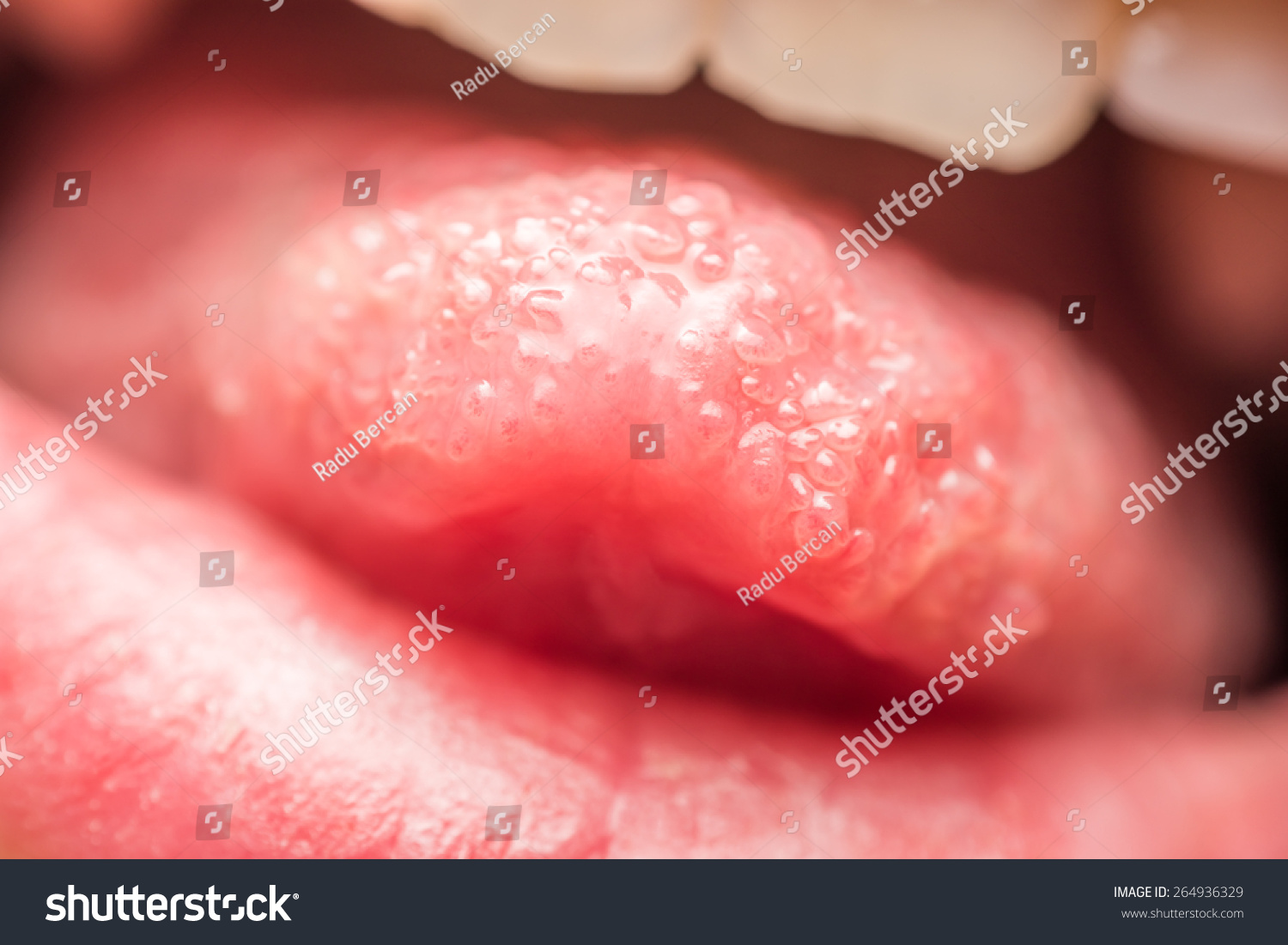 Close Up Pictures Of Human Tongue Papillae 43