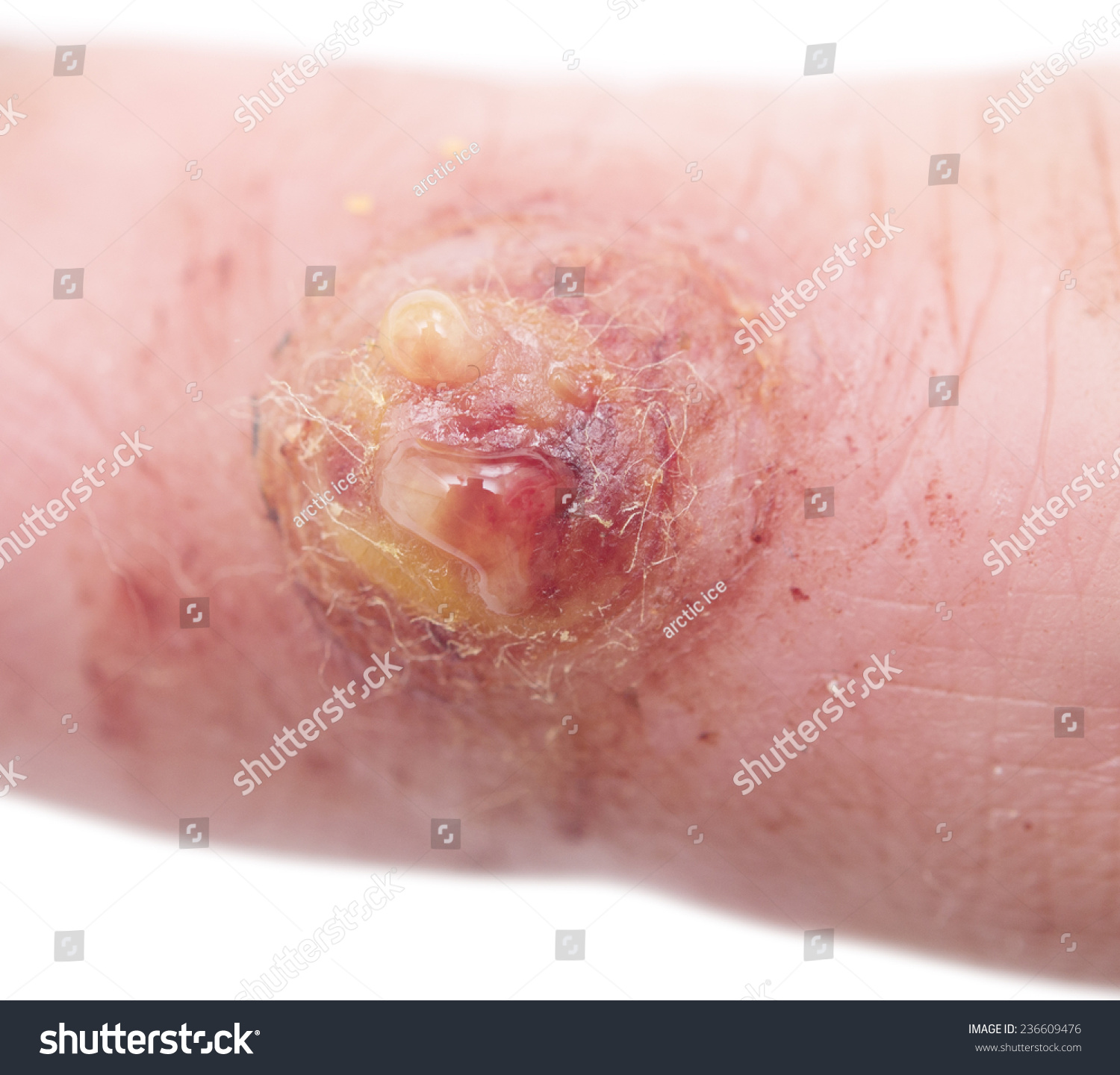 Close Up Shot Of Wart On Finger Stock Photo 23660947