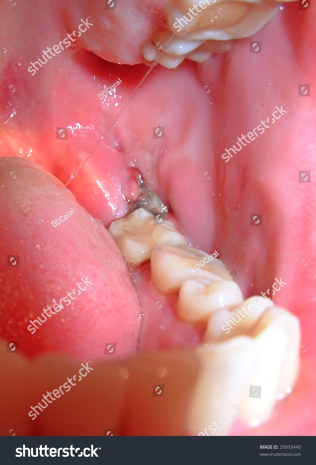 What Does A Blood Clot Look Like After Tooth Removal at Freddie Terry blog