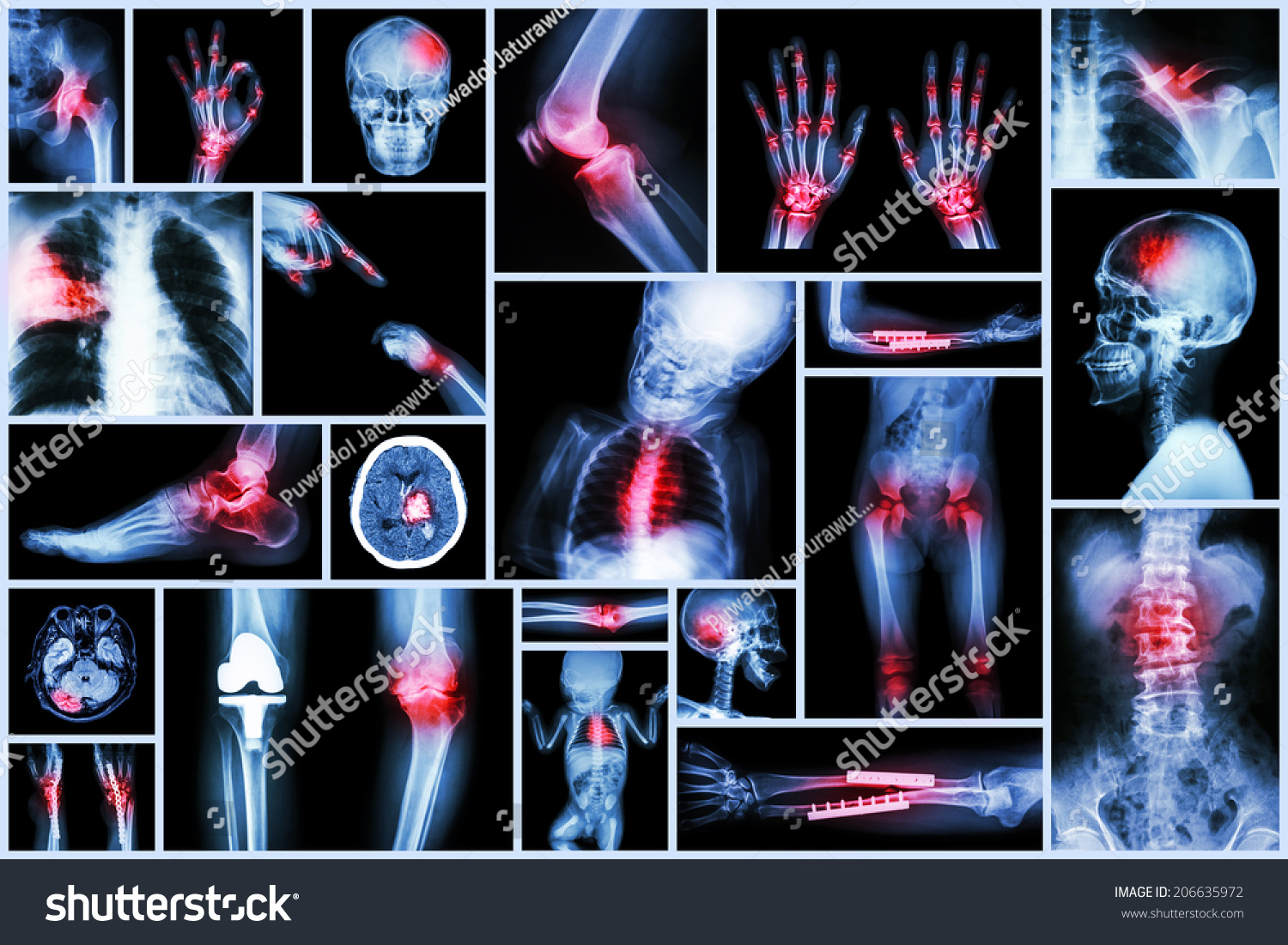 orthopedic surgery &amp; Multiple disease (Pulmonary tuberculosis , Gout ...