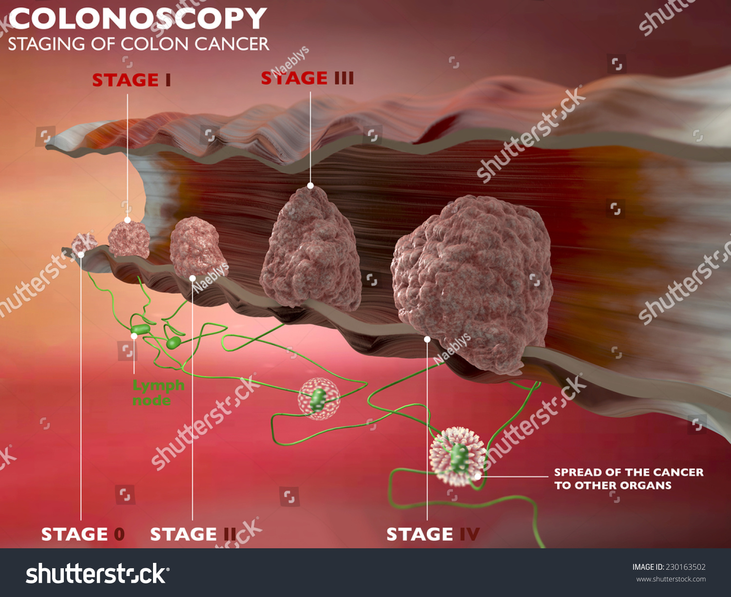 Colonoscopy Examination Colon Digestive System Stock Illustration 230163502 Shutterstock